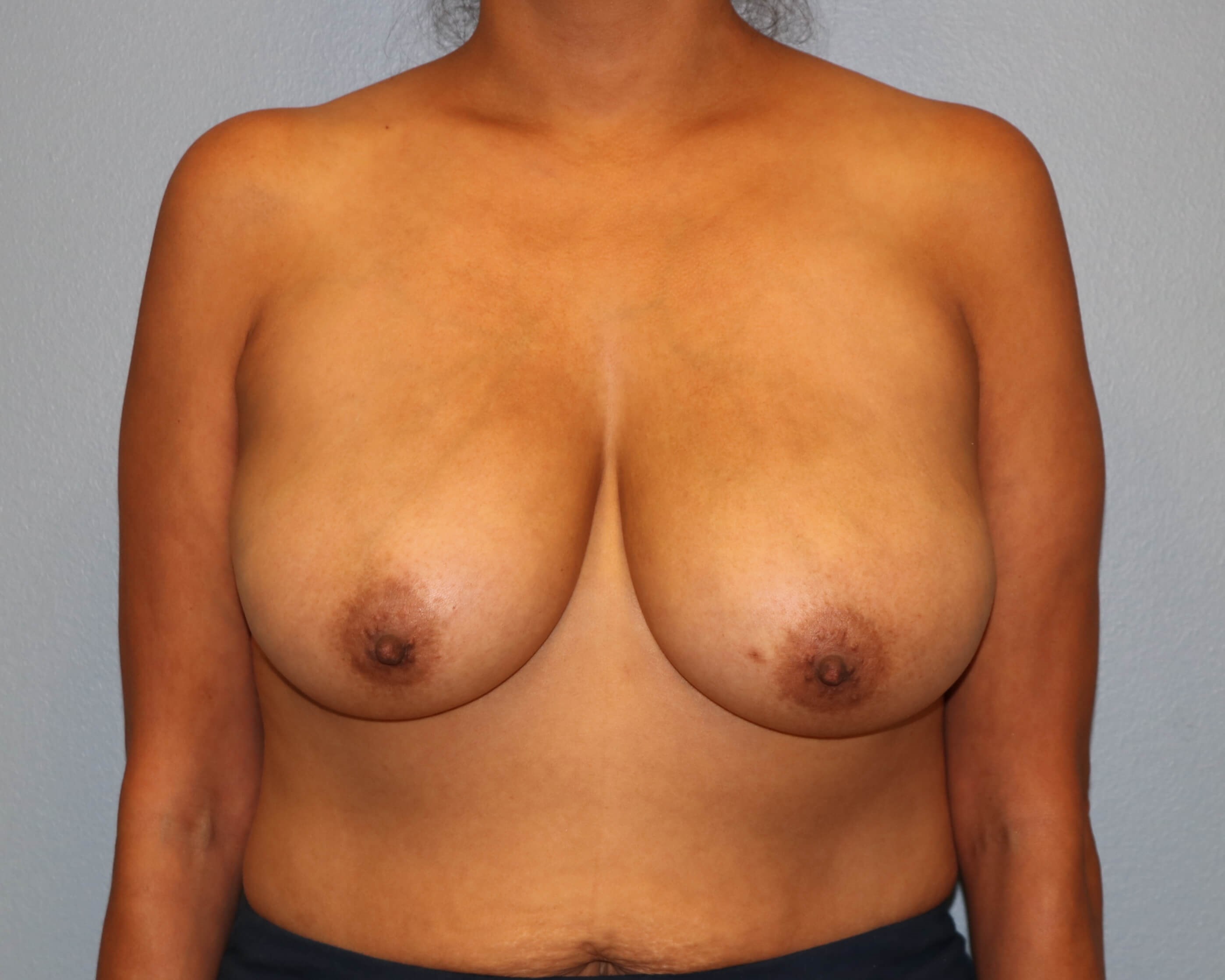 Breast Reduction/Lift Results Before Reduction Mastopexy