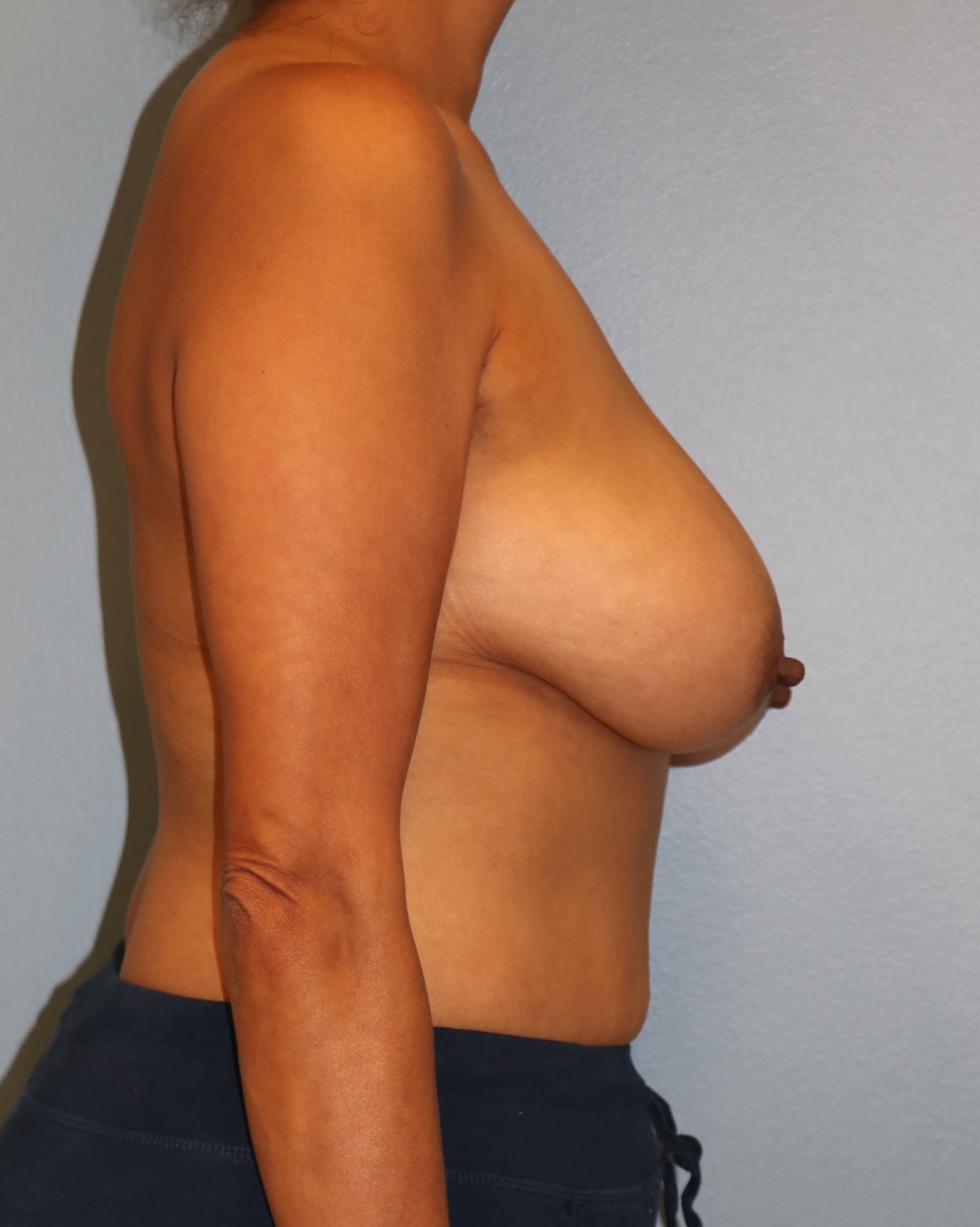 Breast Reduction/Lift Results Before Reduction Mastopexy