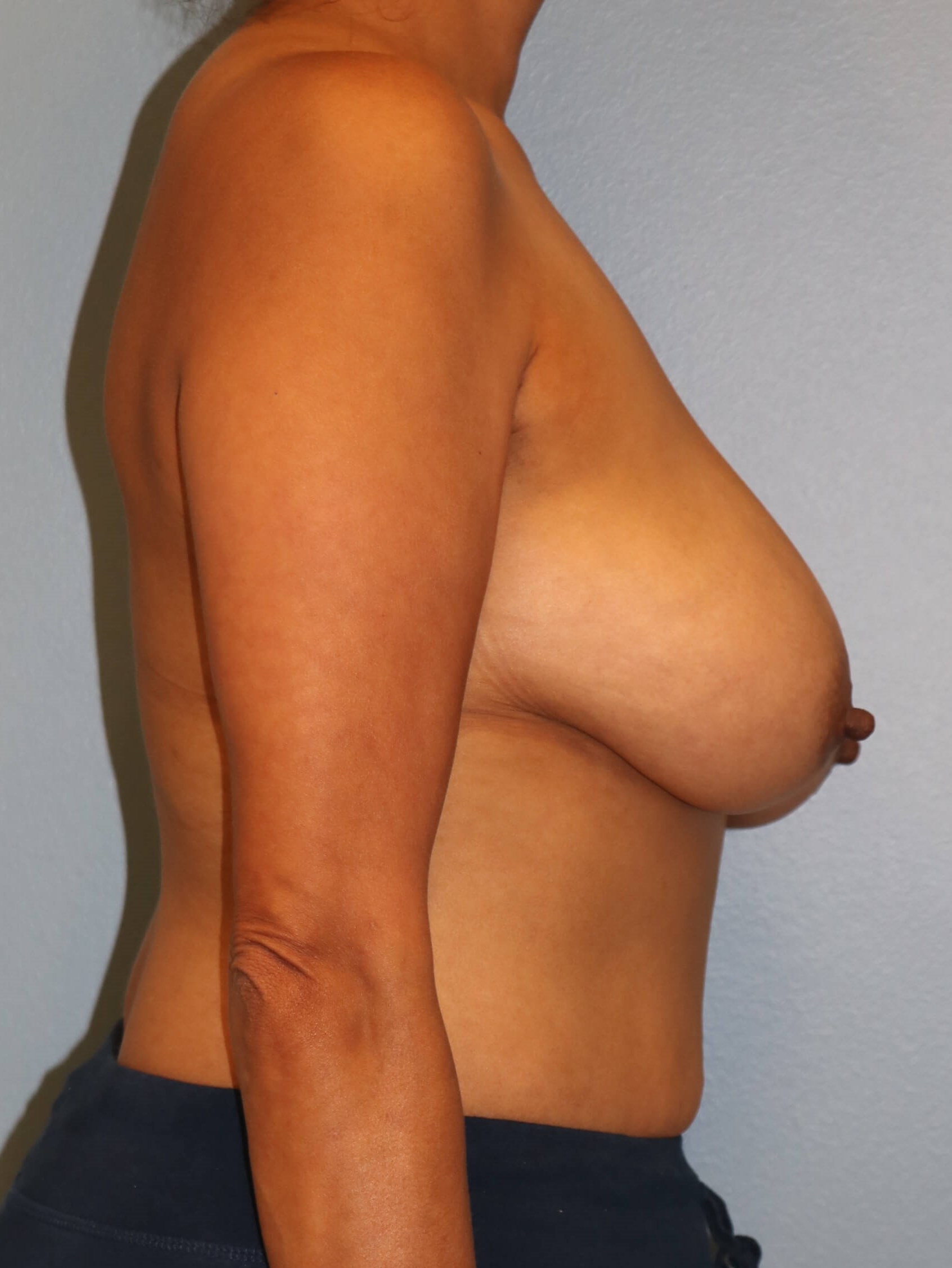 Breast Reduction/Lift Results Before Reduction Mastopexy