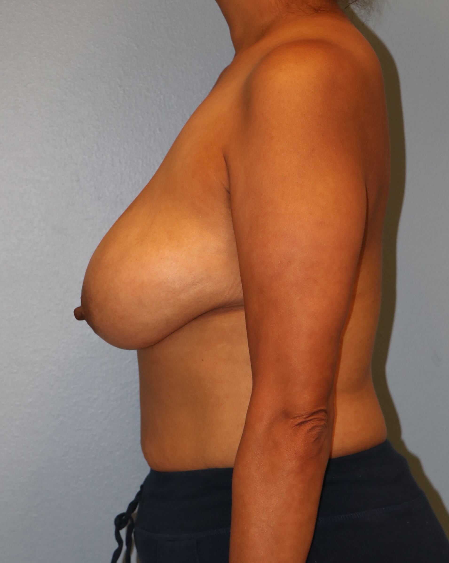 Breast Reduction/Lift Results Before Reduction Mastopexy