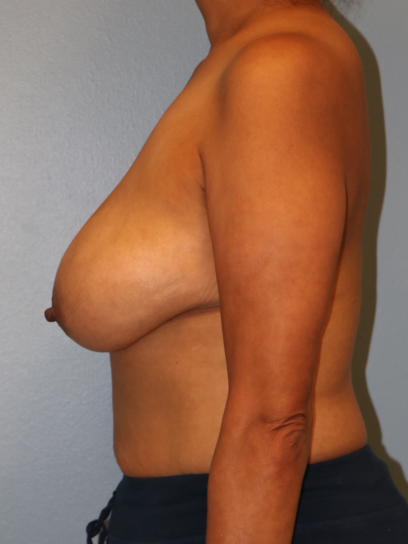 Breast Reduction/Lift Results Before Reduction Mastopexy
