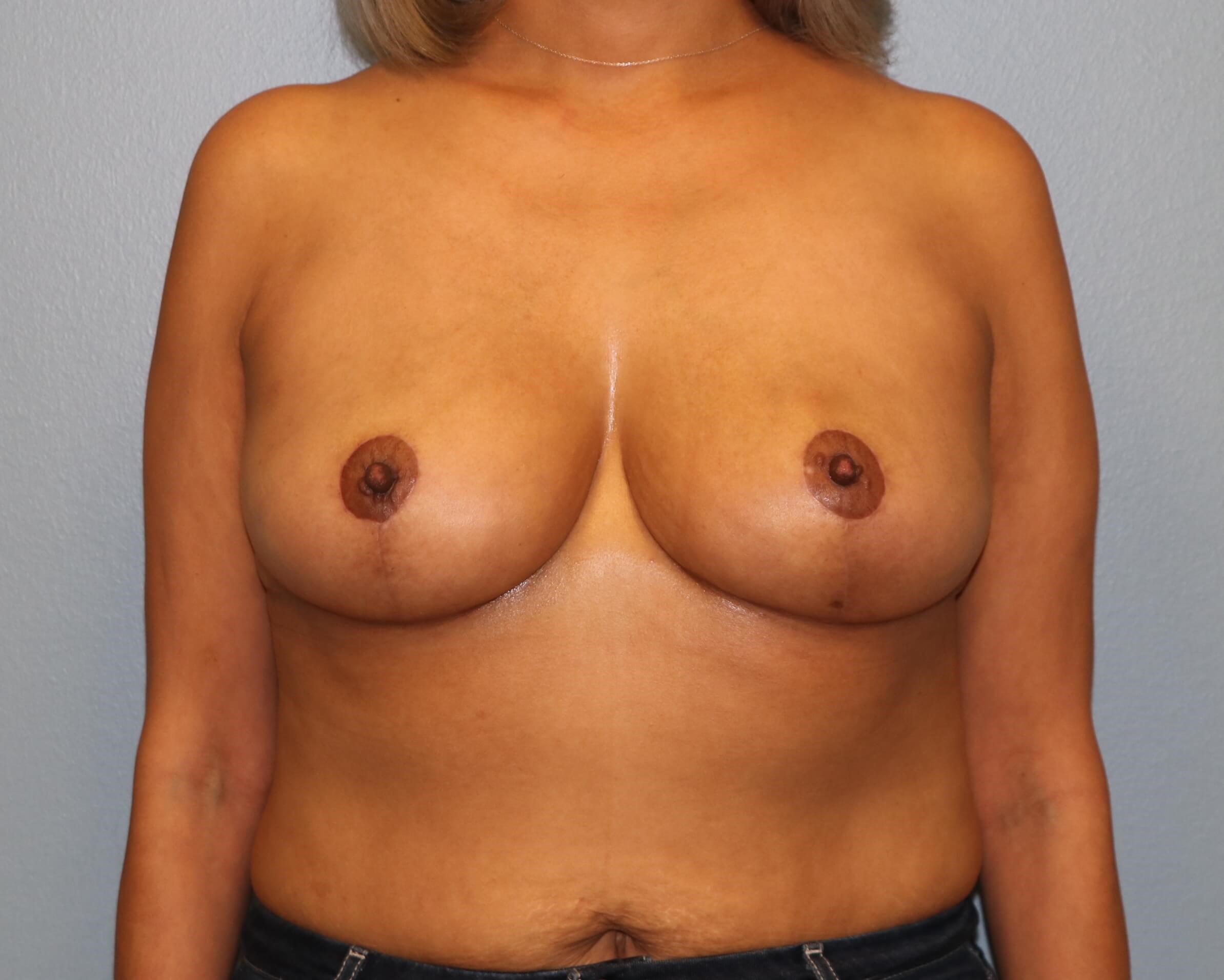 Breast Reduction/Lift Results After Reduction Mastopexy
