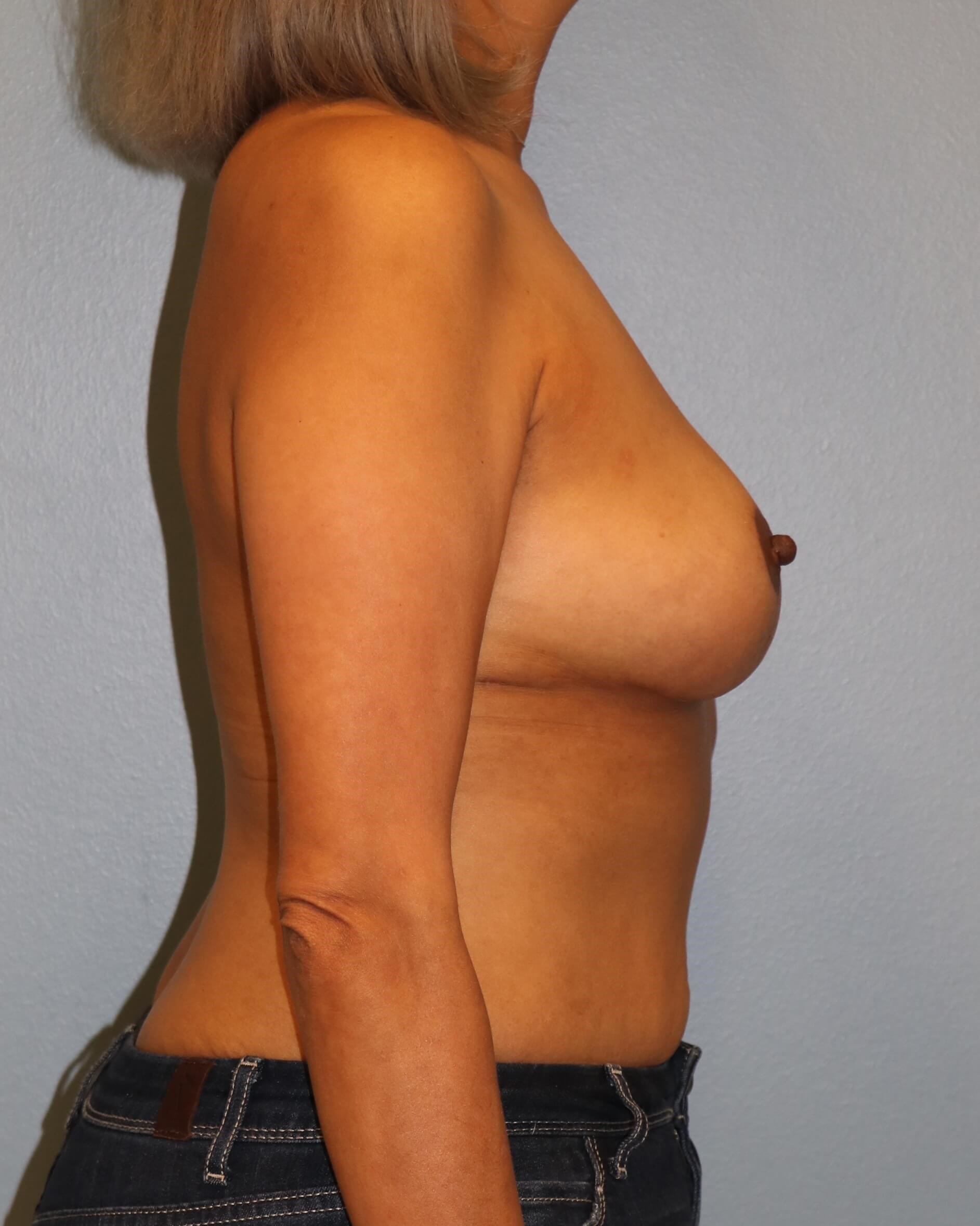 Breast Reduction/Lift Results After Reduction Mastopexy
