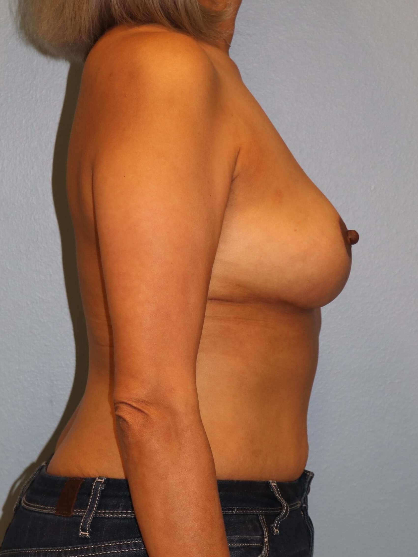 Breast Reduction/Lift Results After Reduction Mastopexy