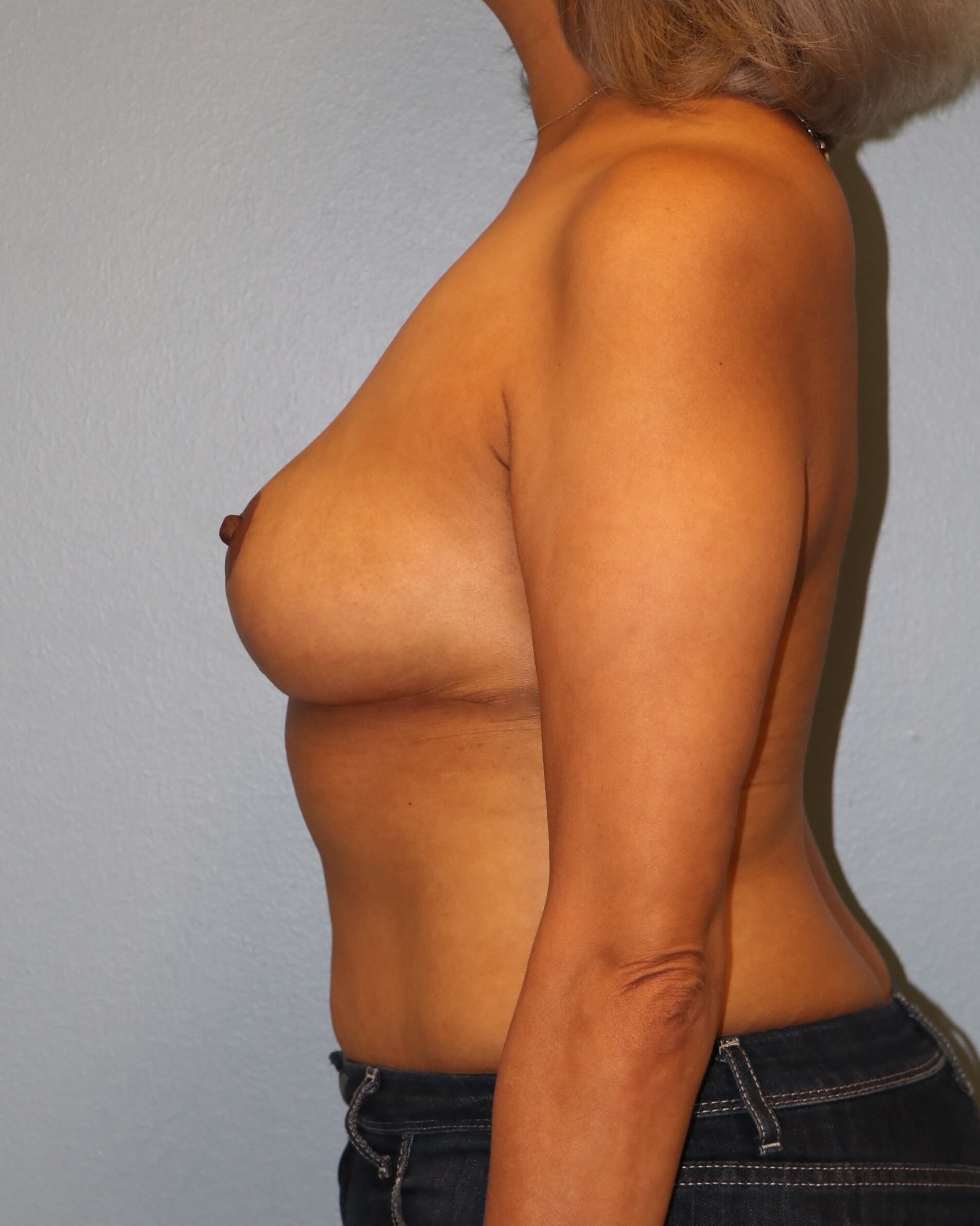 Breast Reduction/Lift Results After Reduction Mastopexy