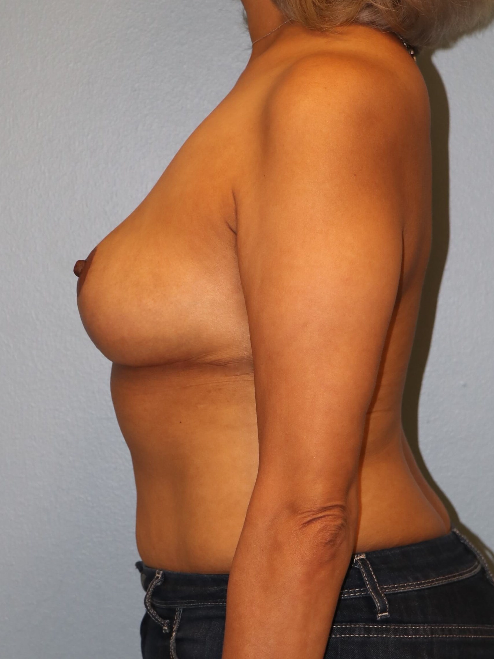 Breast Reduction/Lift Results After Reduction Mastopexy