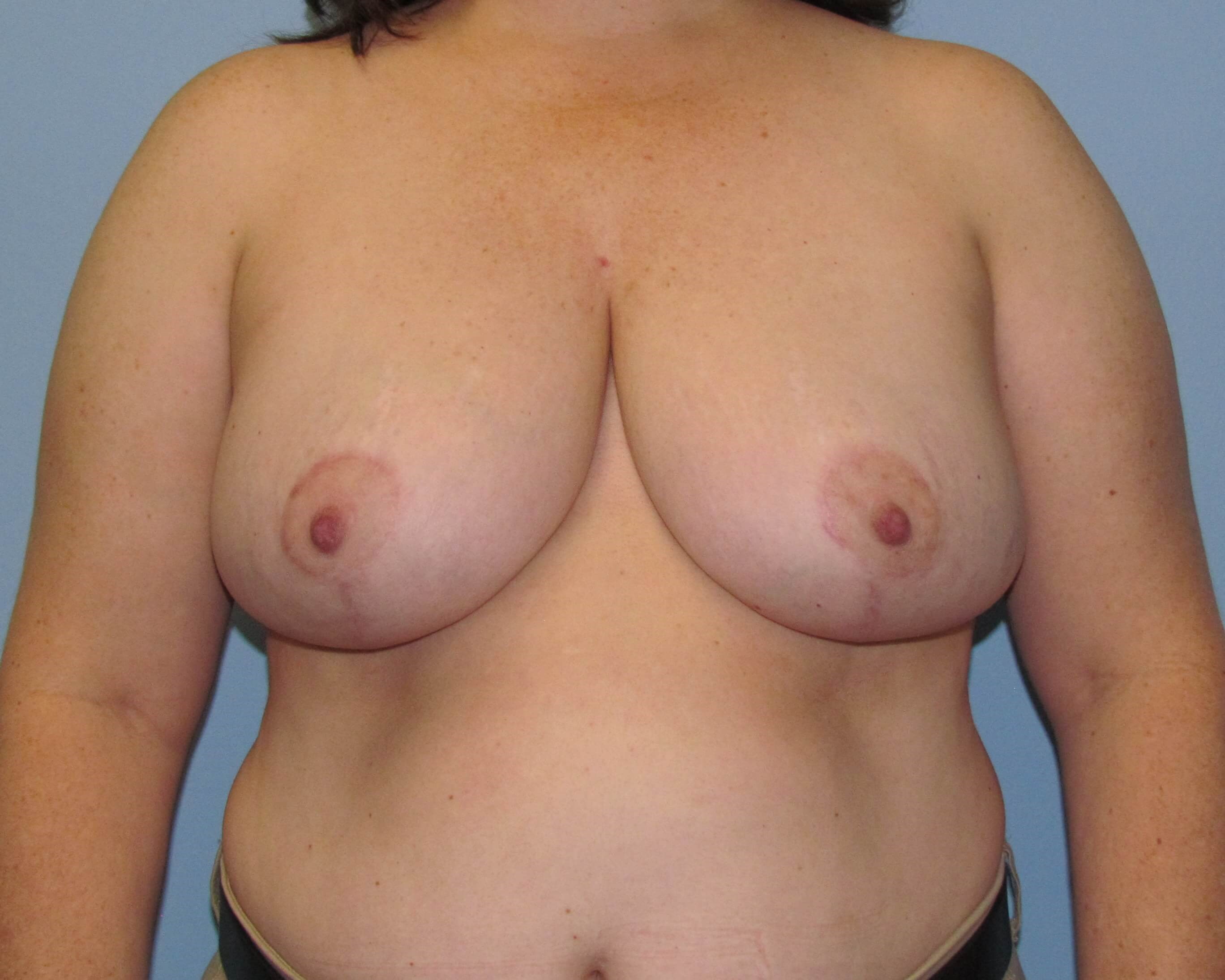 Breast Reduction Before/After After Breast Reduction