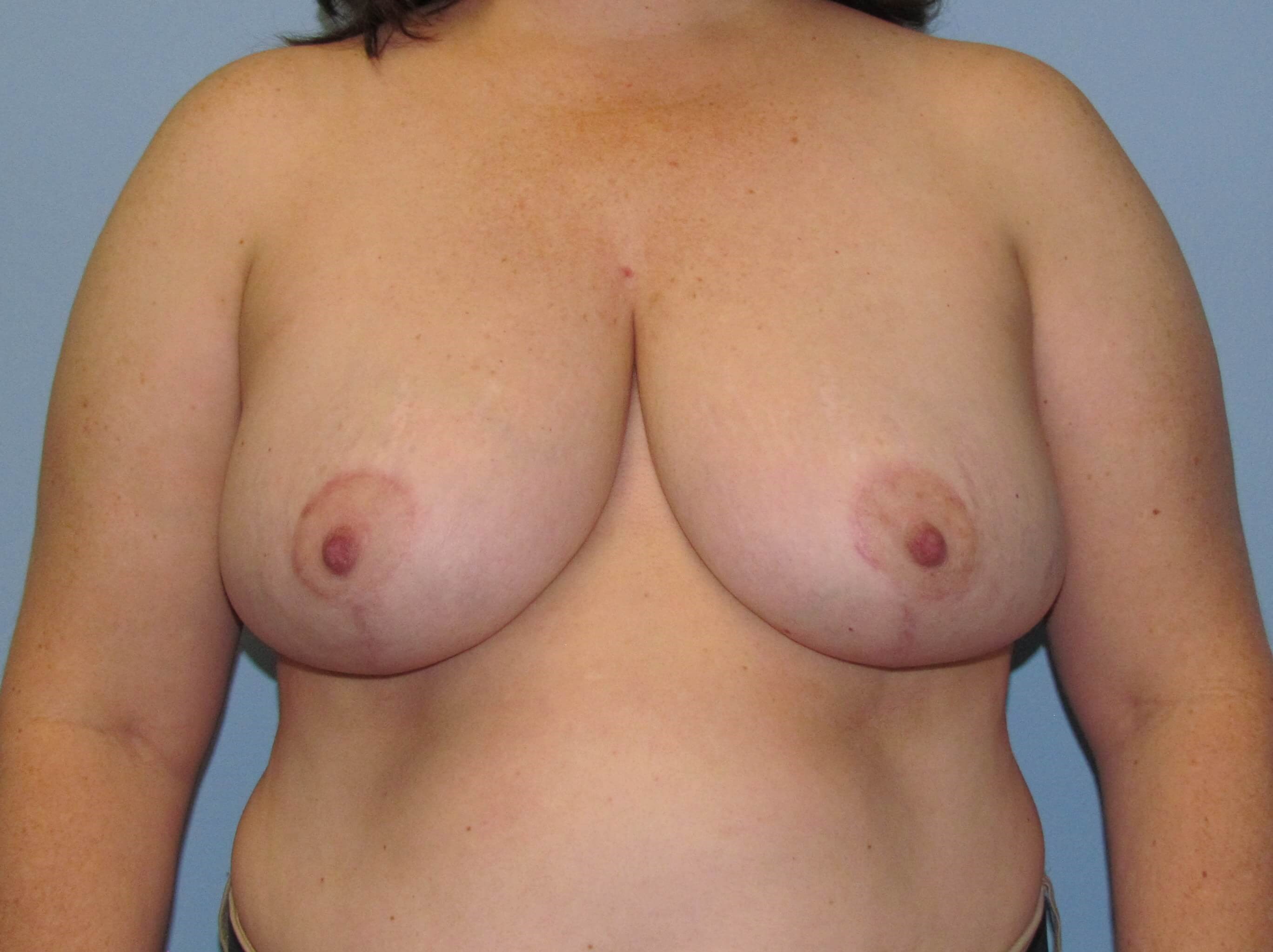 Breast Reduction Before/After After Breast Reduction
