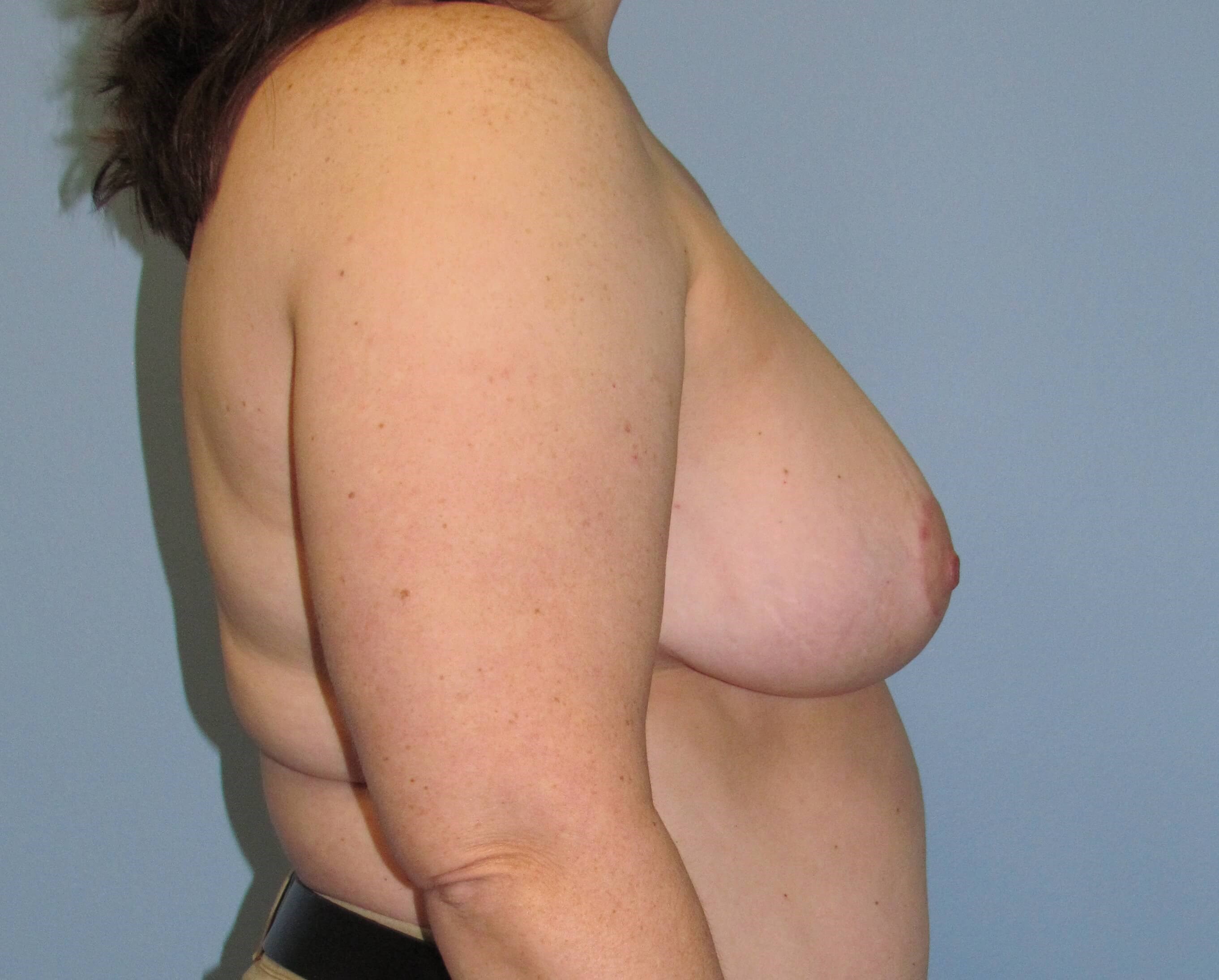 Breast Reduction Before/After After Breast Reduction