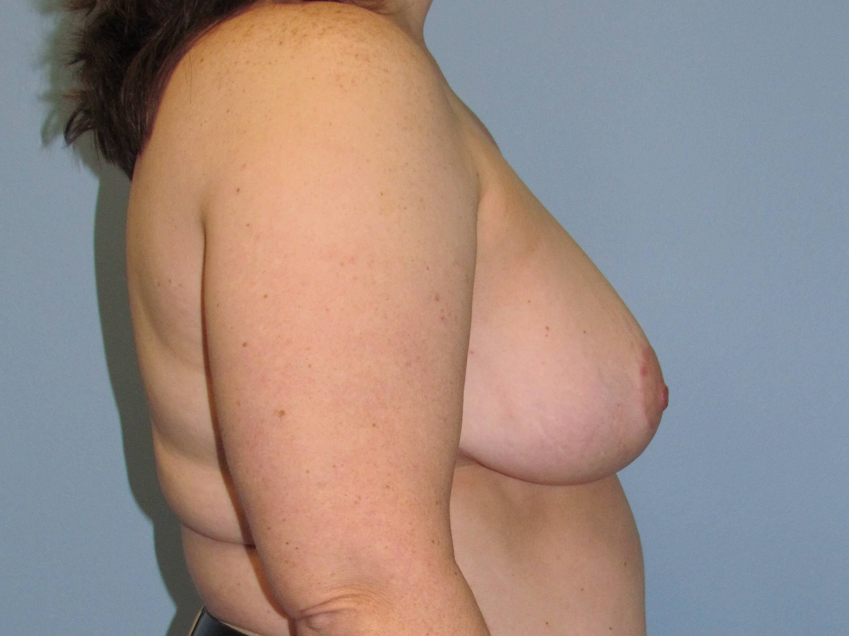 Breast Reduction Before/After After Breast Reduction