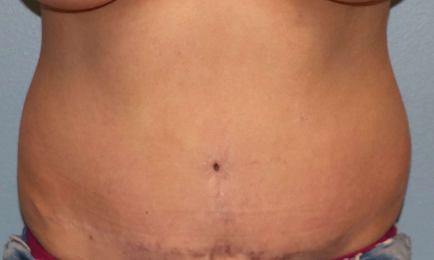 Belly Button Revision & Lipo Before Tummy Tuck Revision