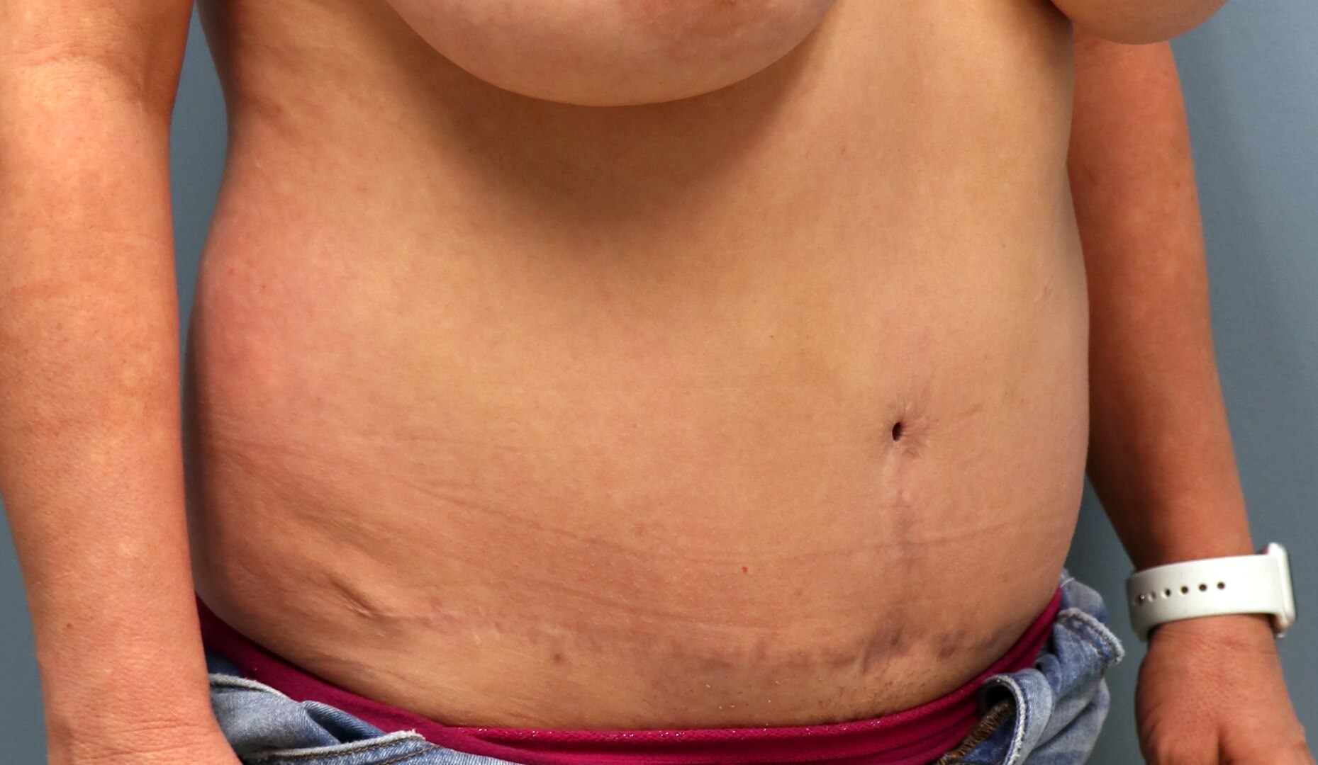 Belly Button Revision & Lipo Before Tummy Tuck Revision