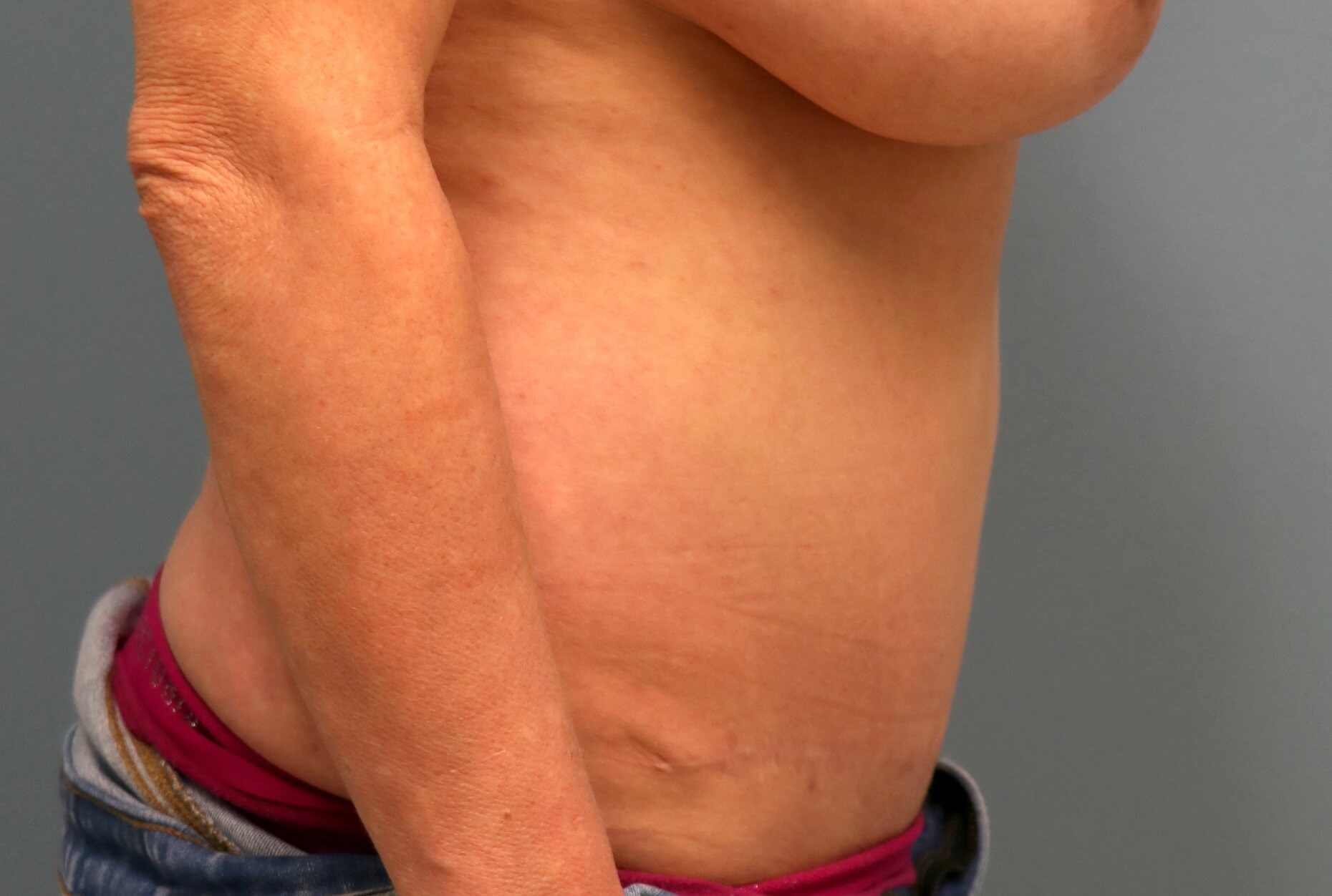 Belly Button Revision & Lipo Before Tummy Tuck Revision