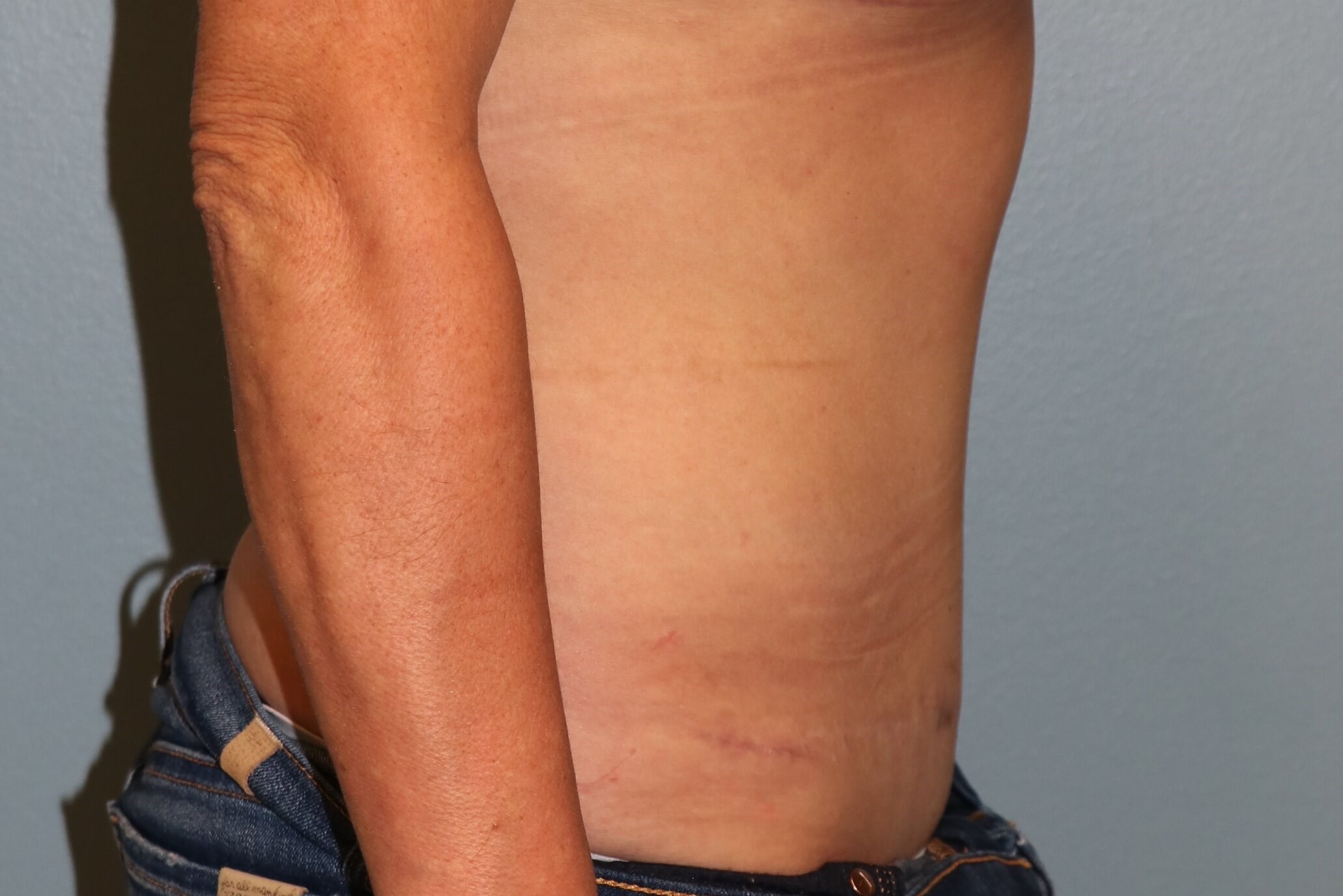 Belly Button Revision & Lipo After Tummy Tuck Revision