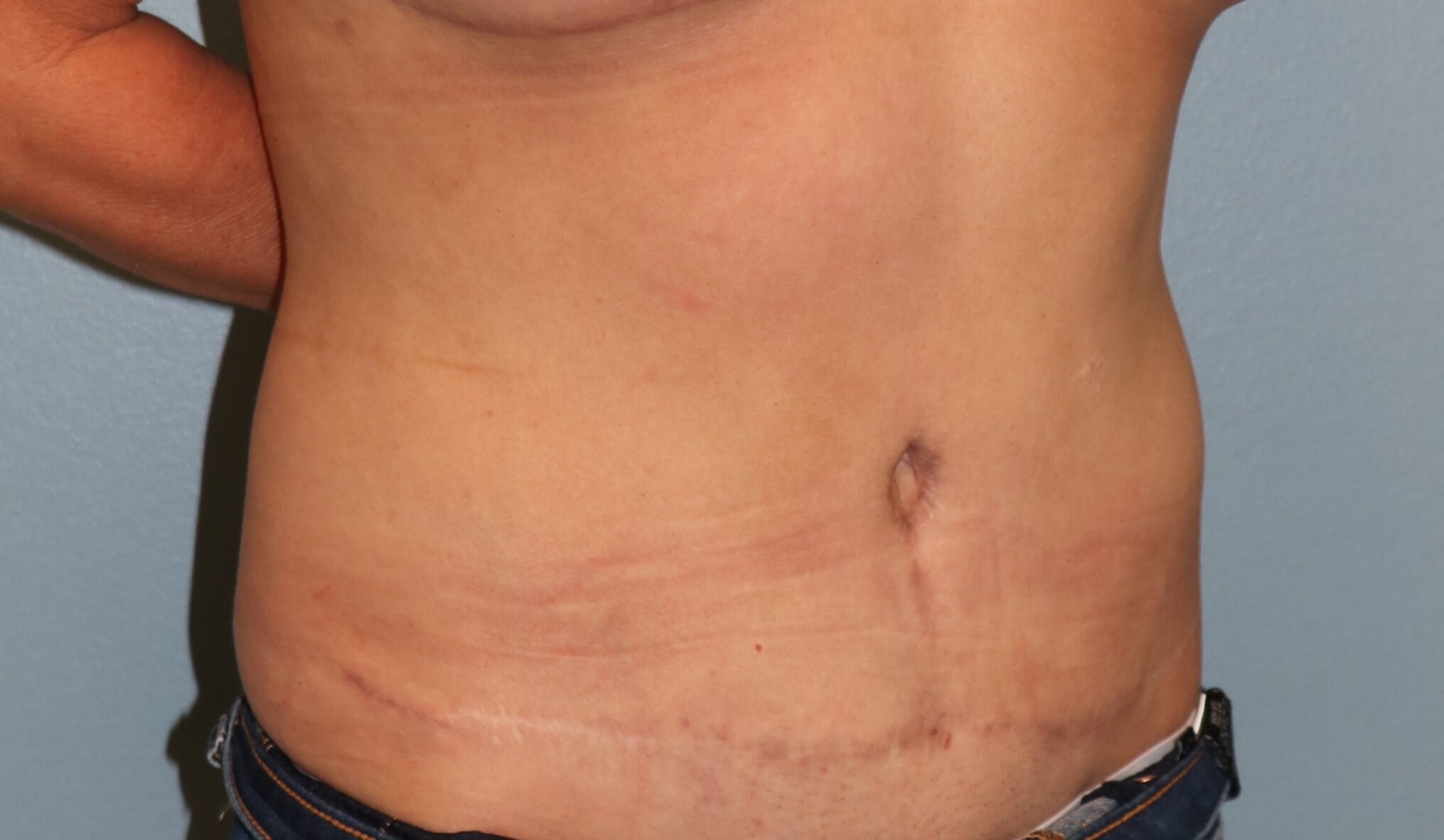 Belly Button Revision & Lipo After Tummy Tuck Revision