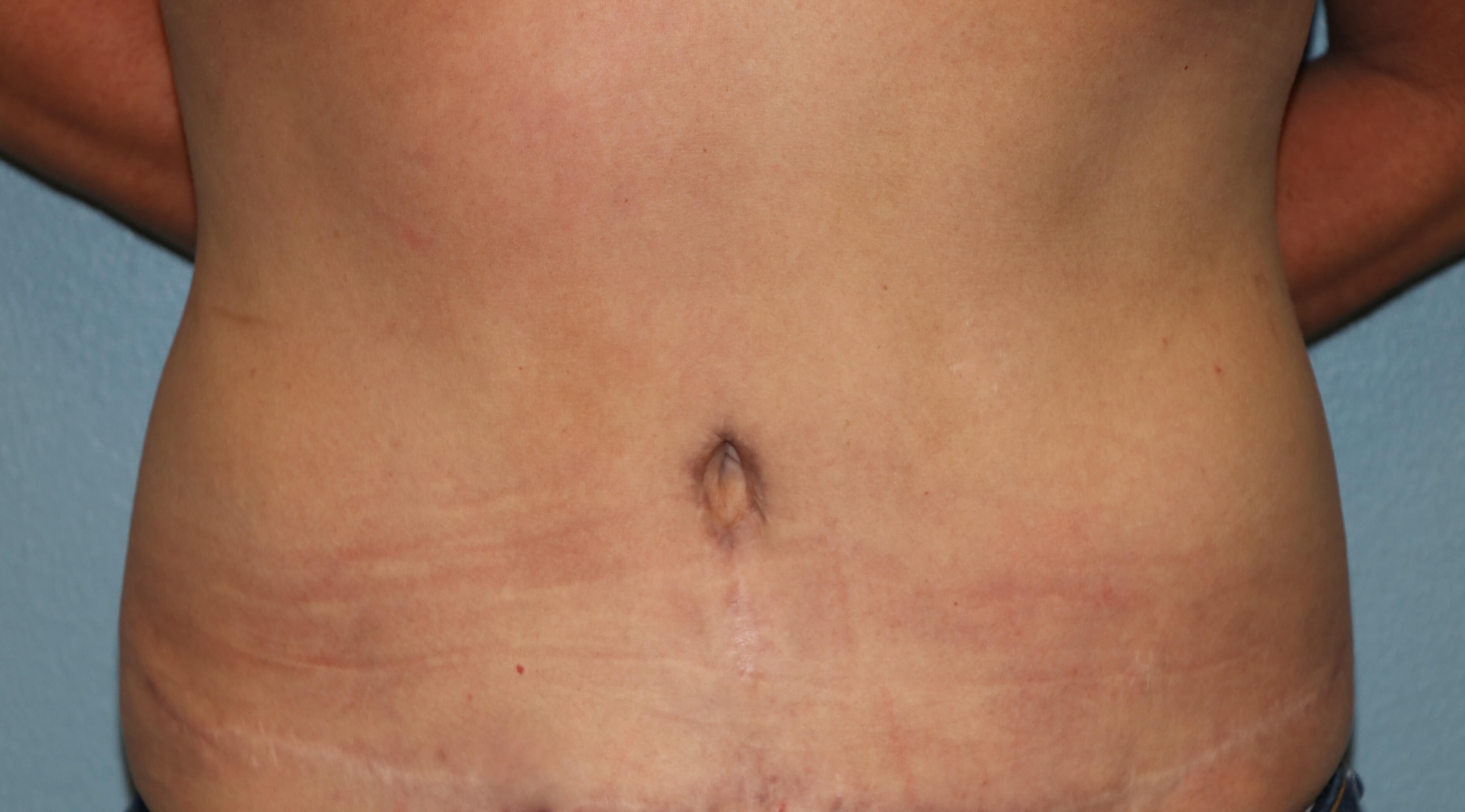 Belly Button Revision & Lipo After Tummy Tuck Revision