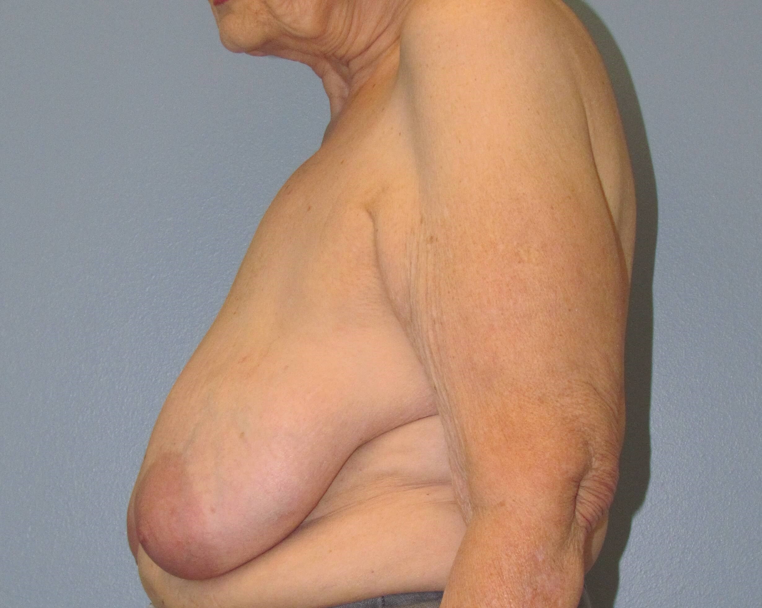 Oncoplastic Breast Lift Before Lumpectomy