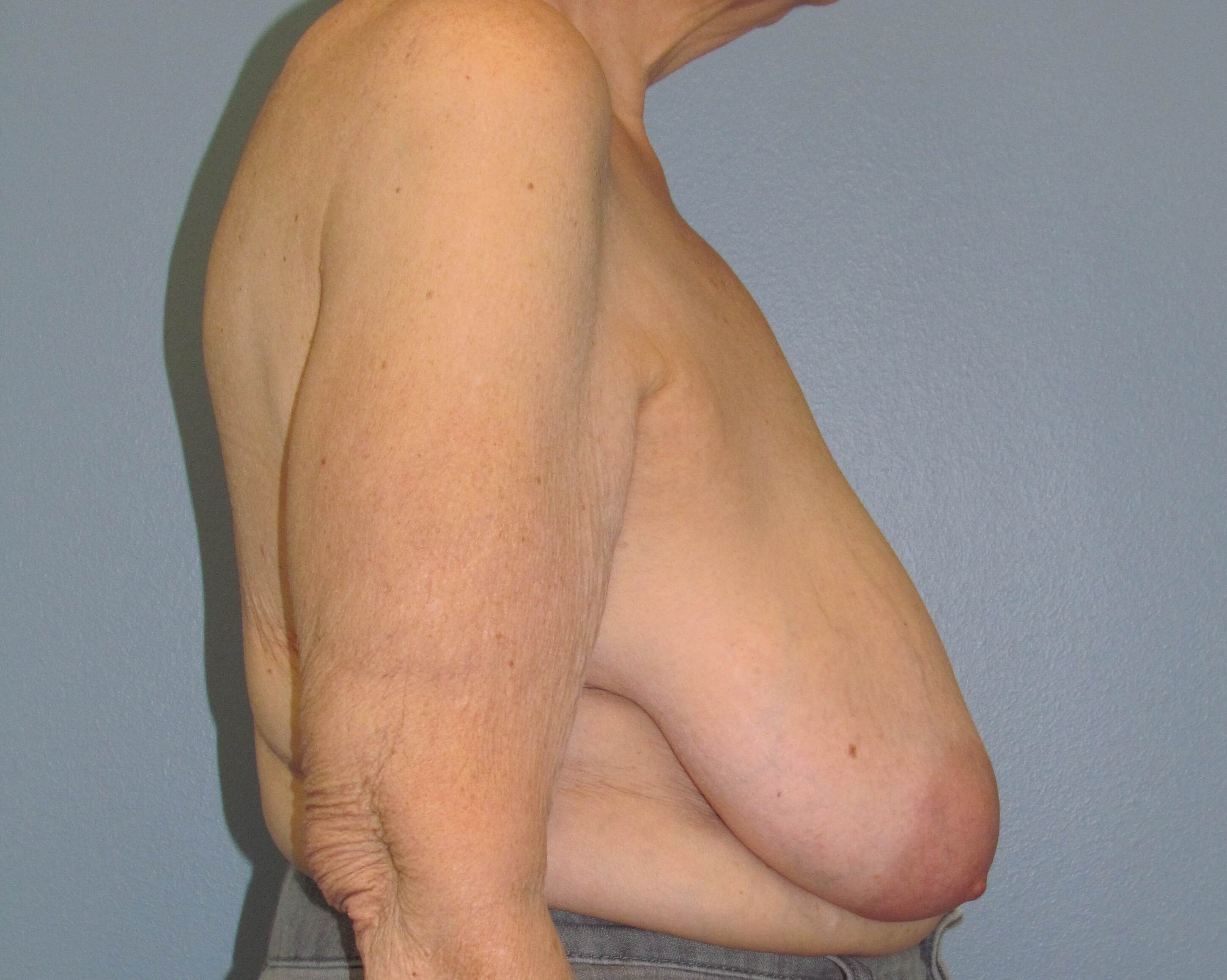 Oncoplastic Breast Lift Before Lumpectomy