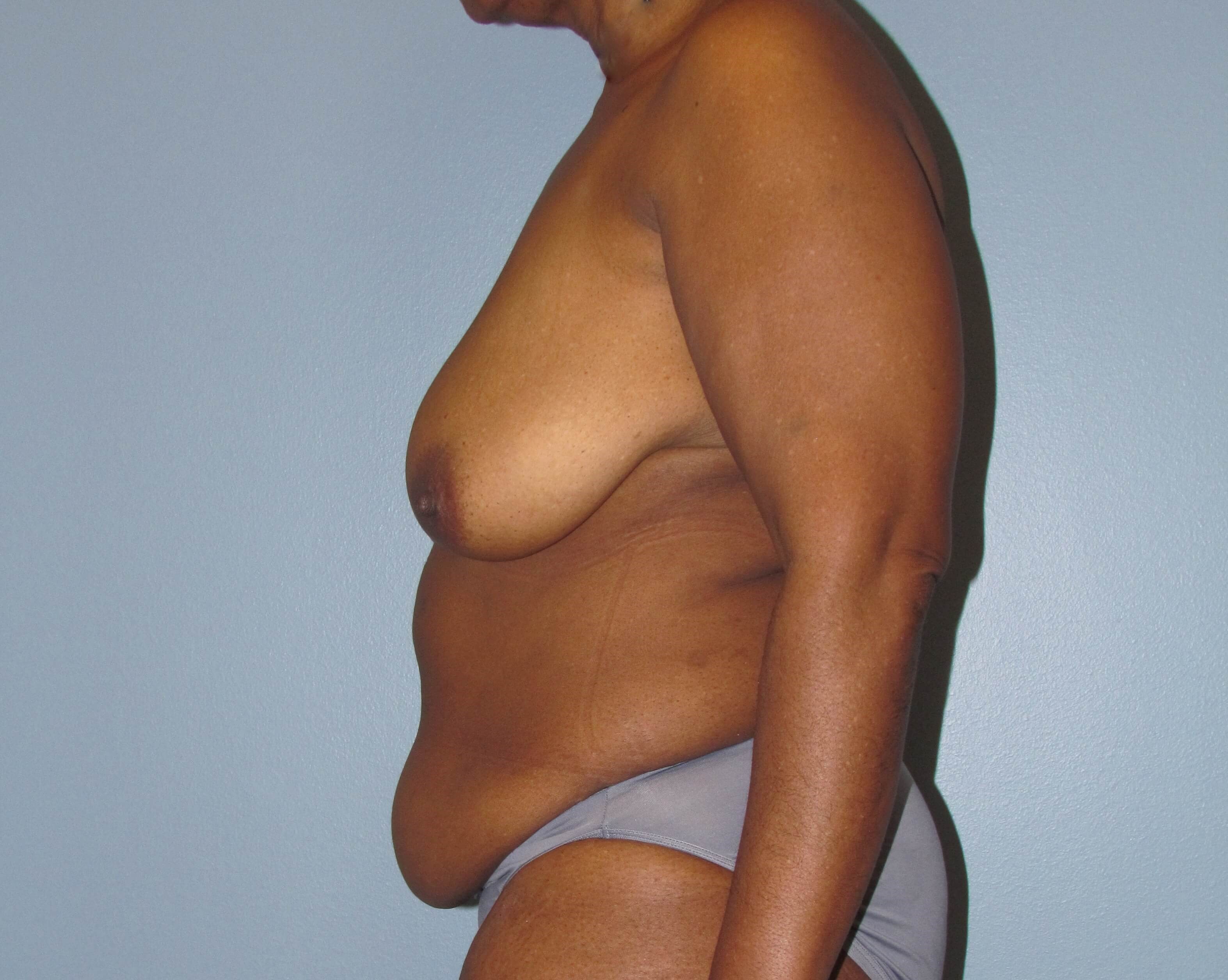 Mommy Makeover Before & After Before Mommy Makeover