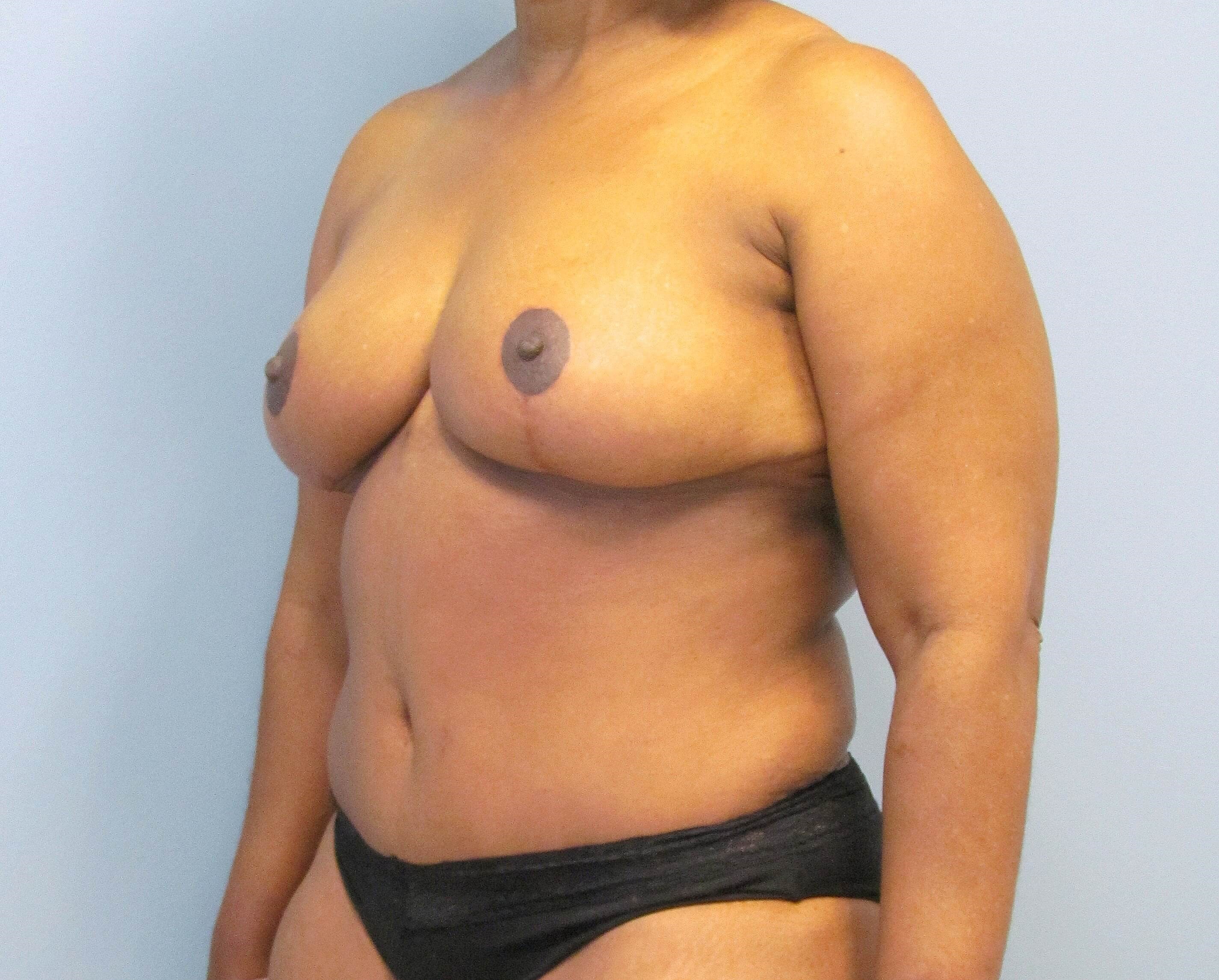 Mommy Makeover Before & After After Mommy Makeover
