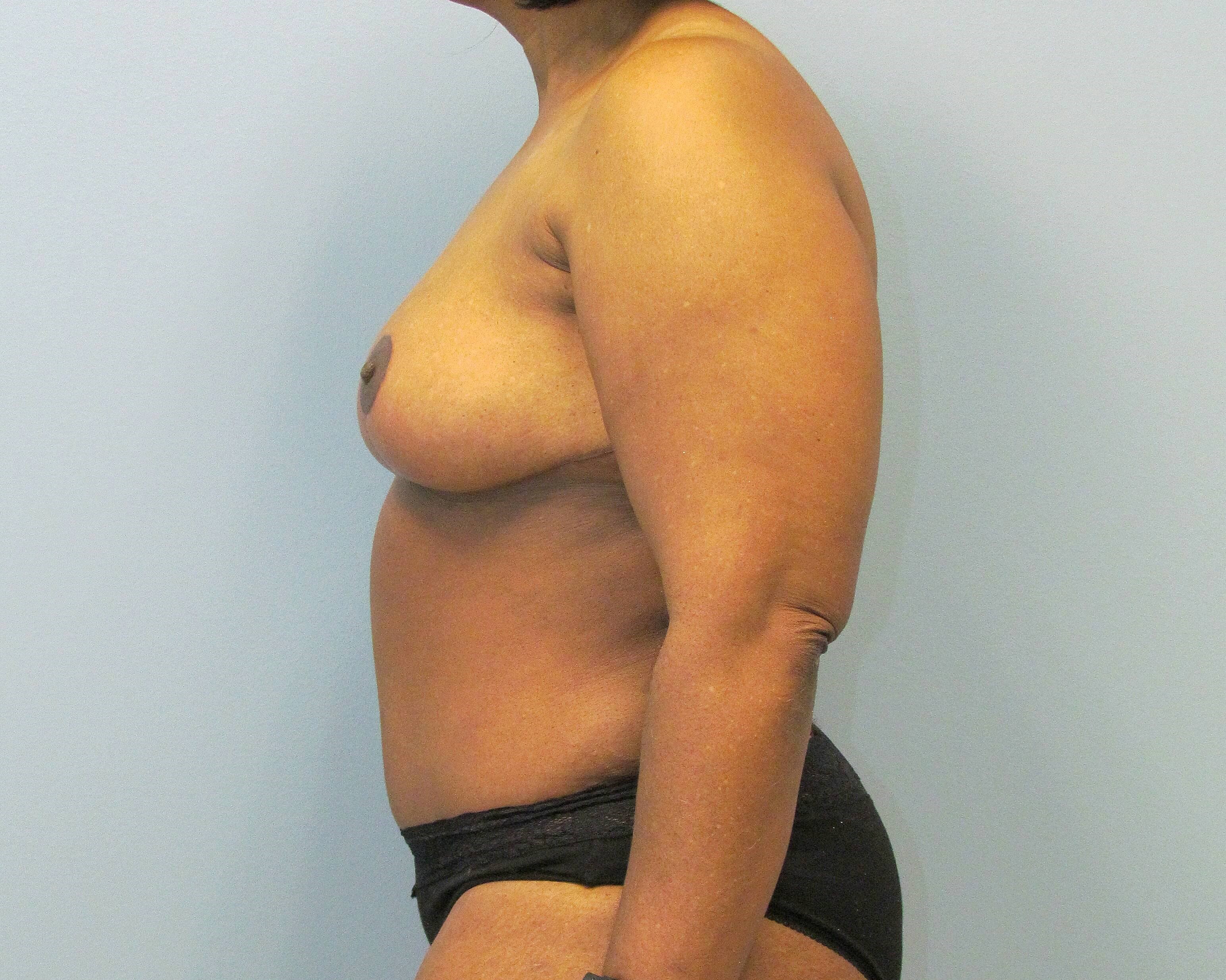 Mommy Makeover Before & After After Mommy Makeover