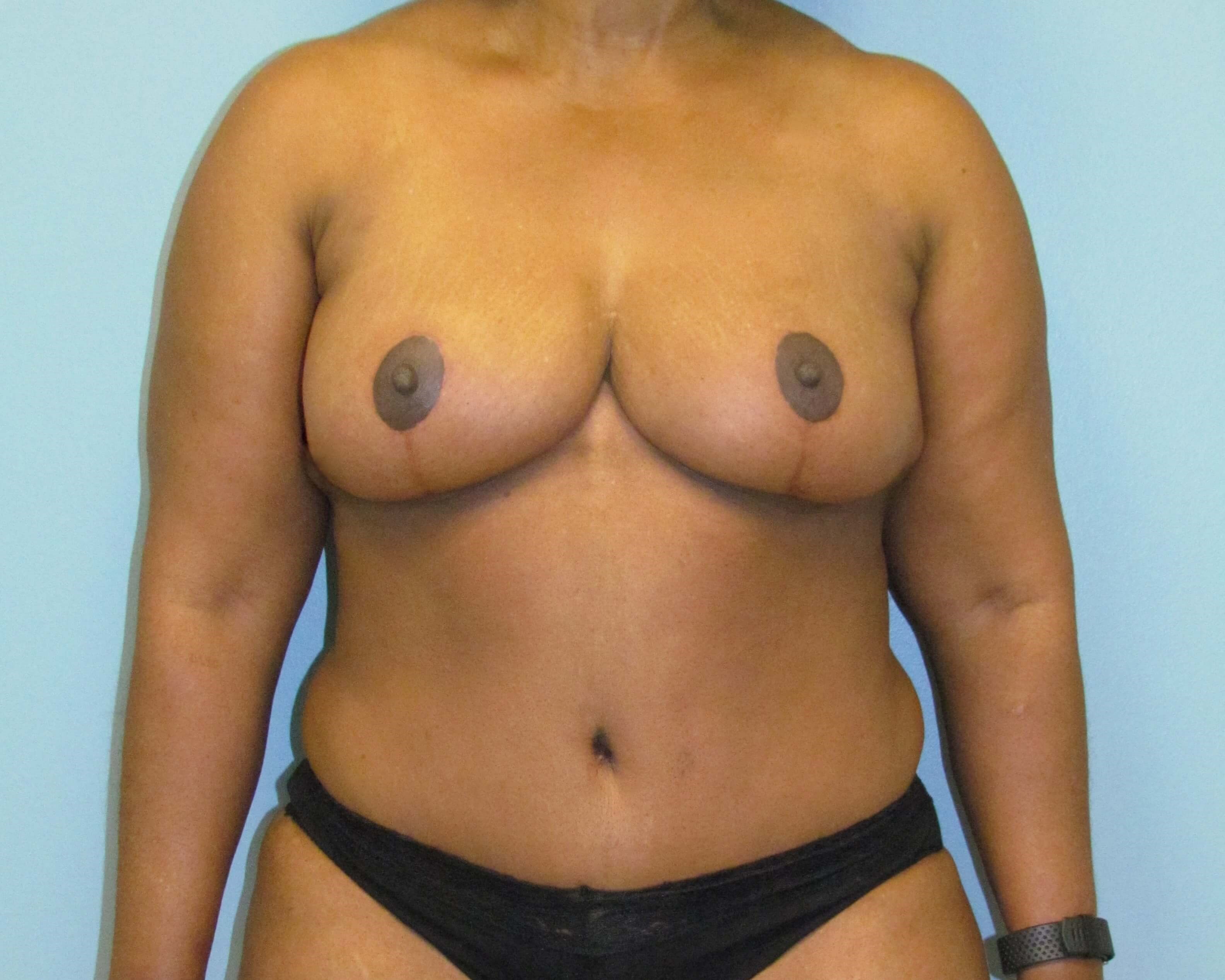Mommy Makeover Before & After After Mommy Makeover