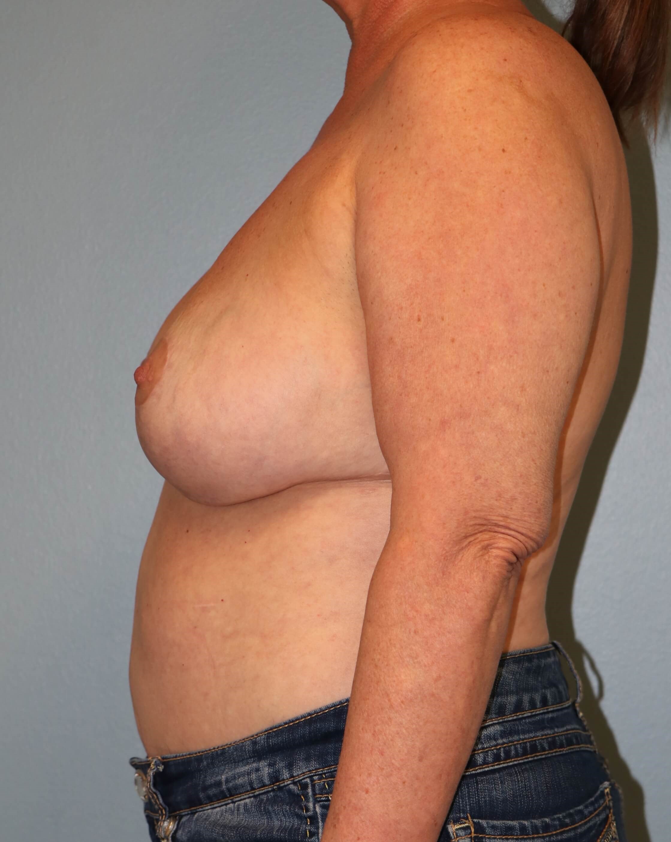 Reduction & Implant Exchange After Oncoplastic Reduction