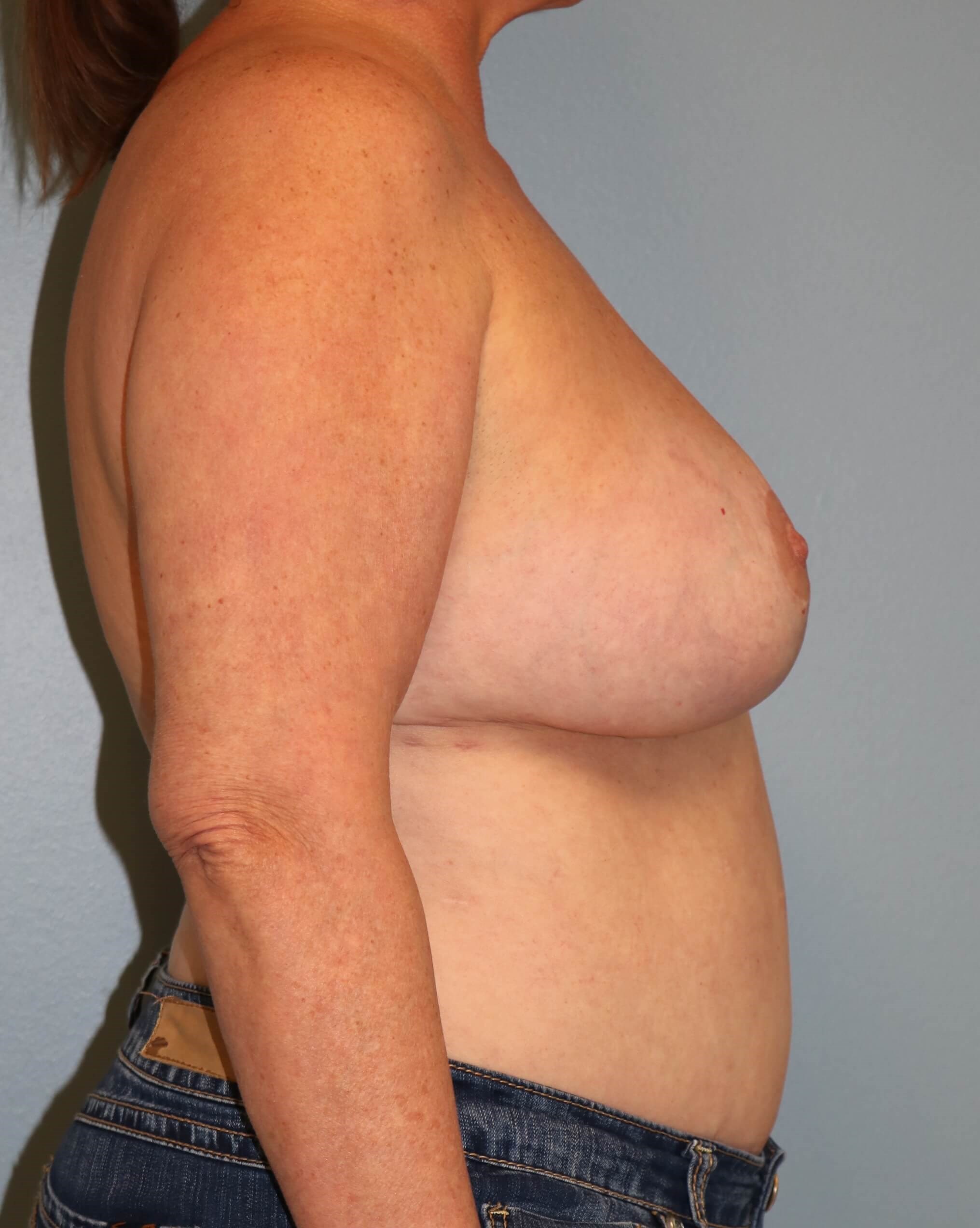 Reduction & Implant Exchange After Oncoplastic Reduction
