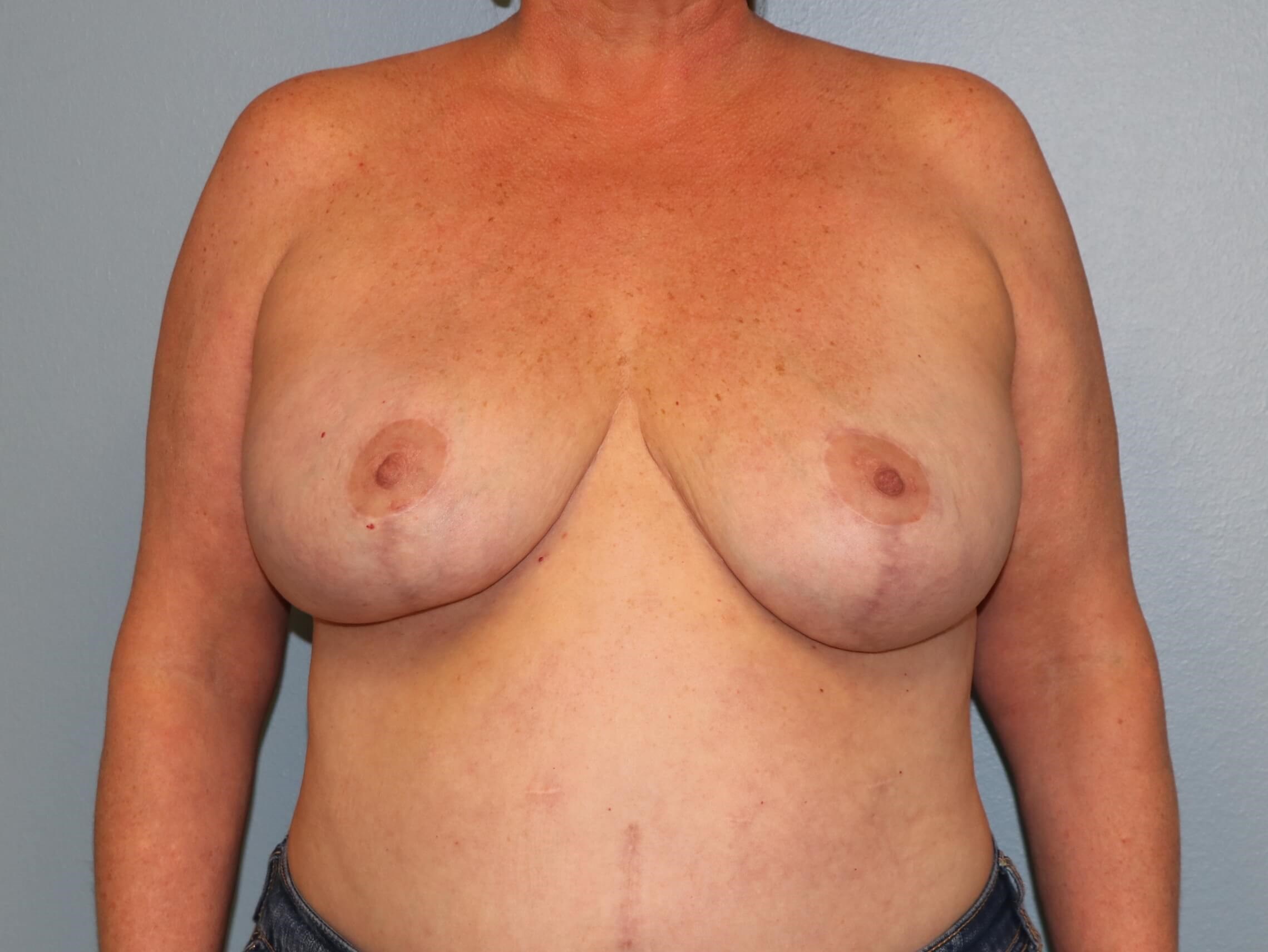 Reduction & Implant Exchange After Oncoplastic Reduction