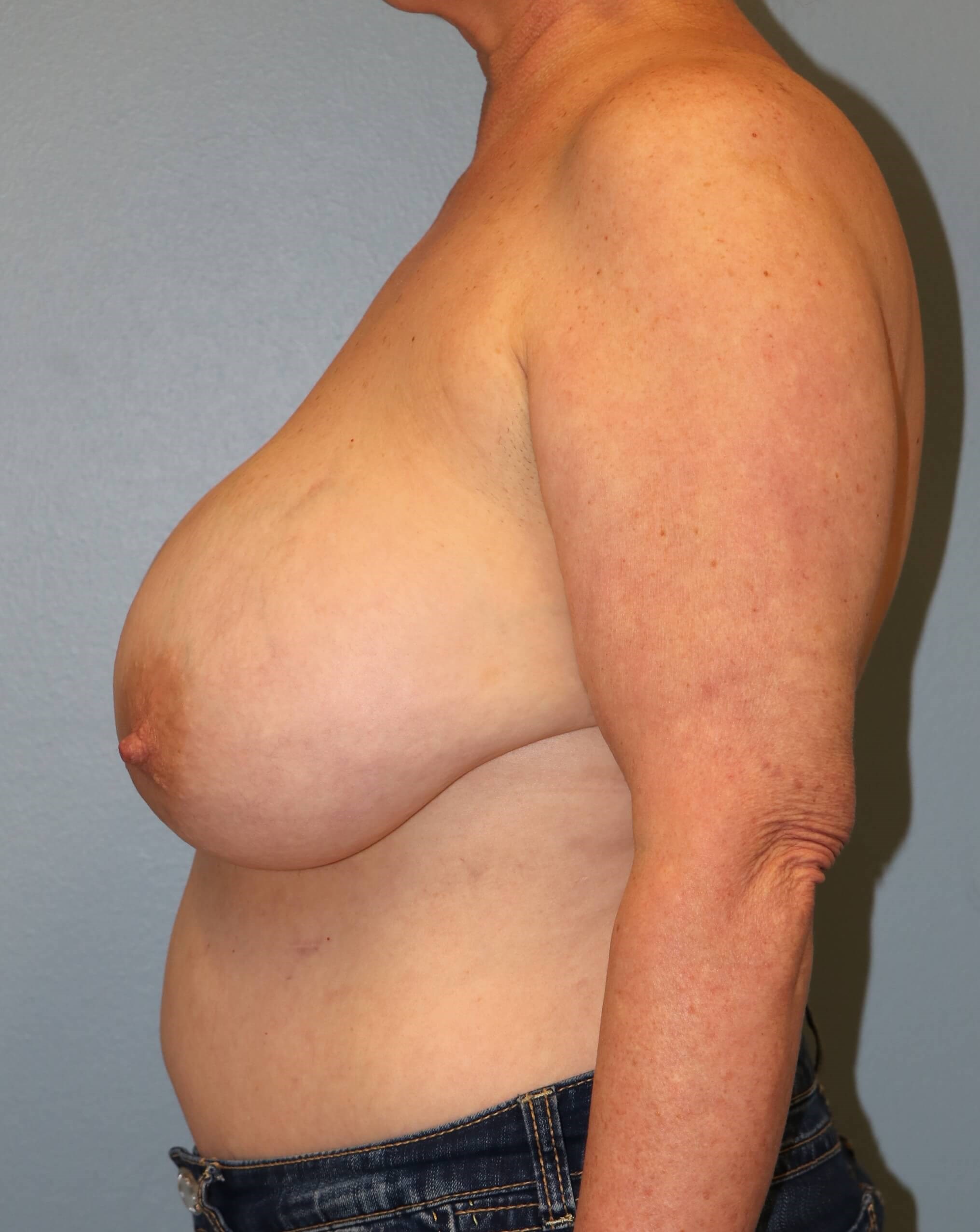 Reduction & Implant Exchange Before Right Lumpectomy