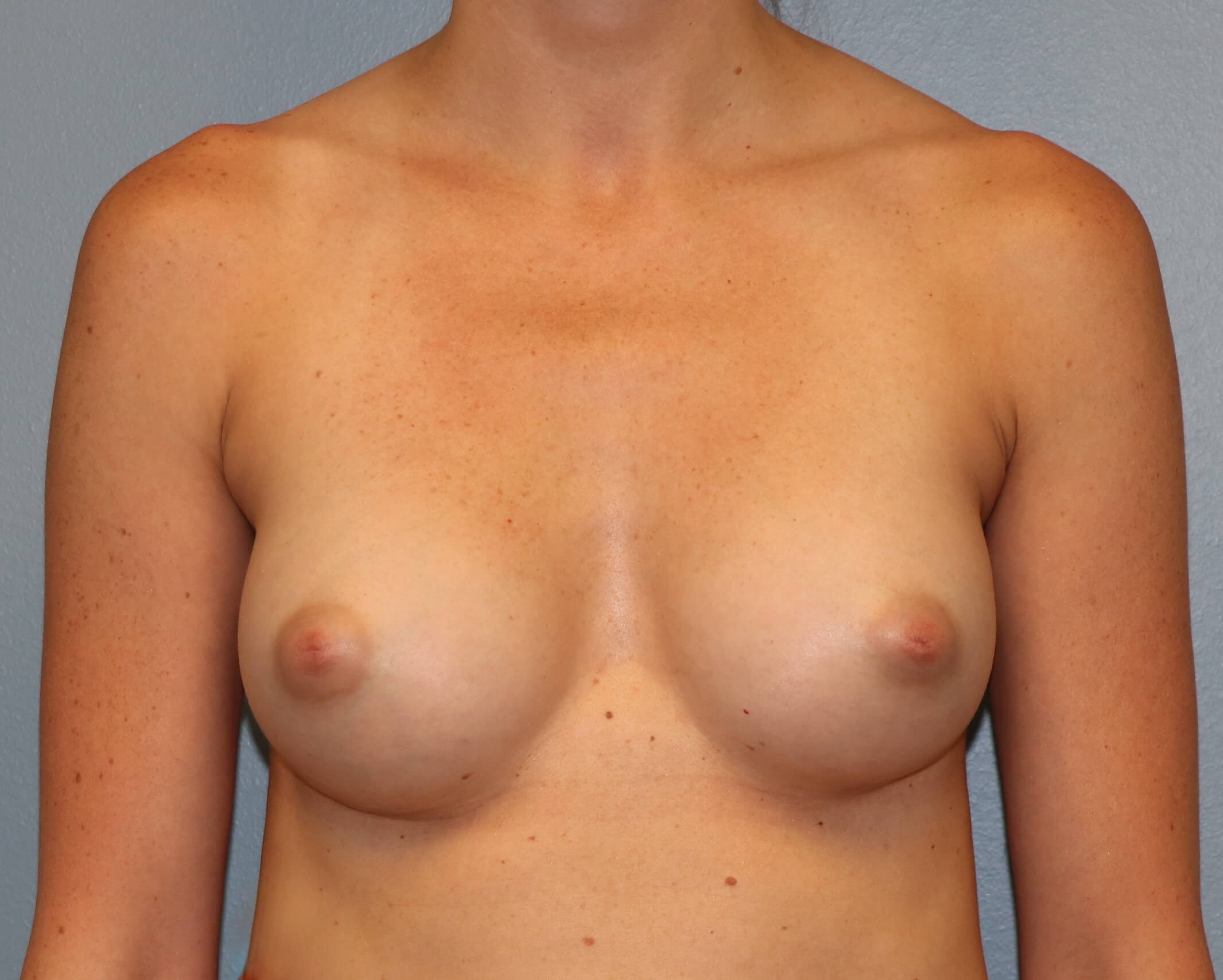 Breast Aug Before & After After Breast Augmentation