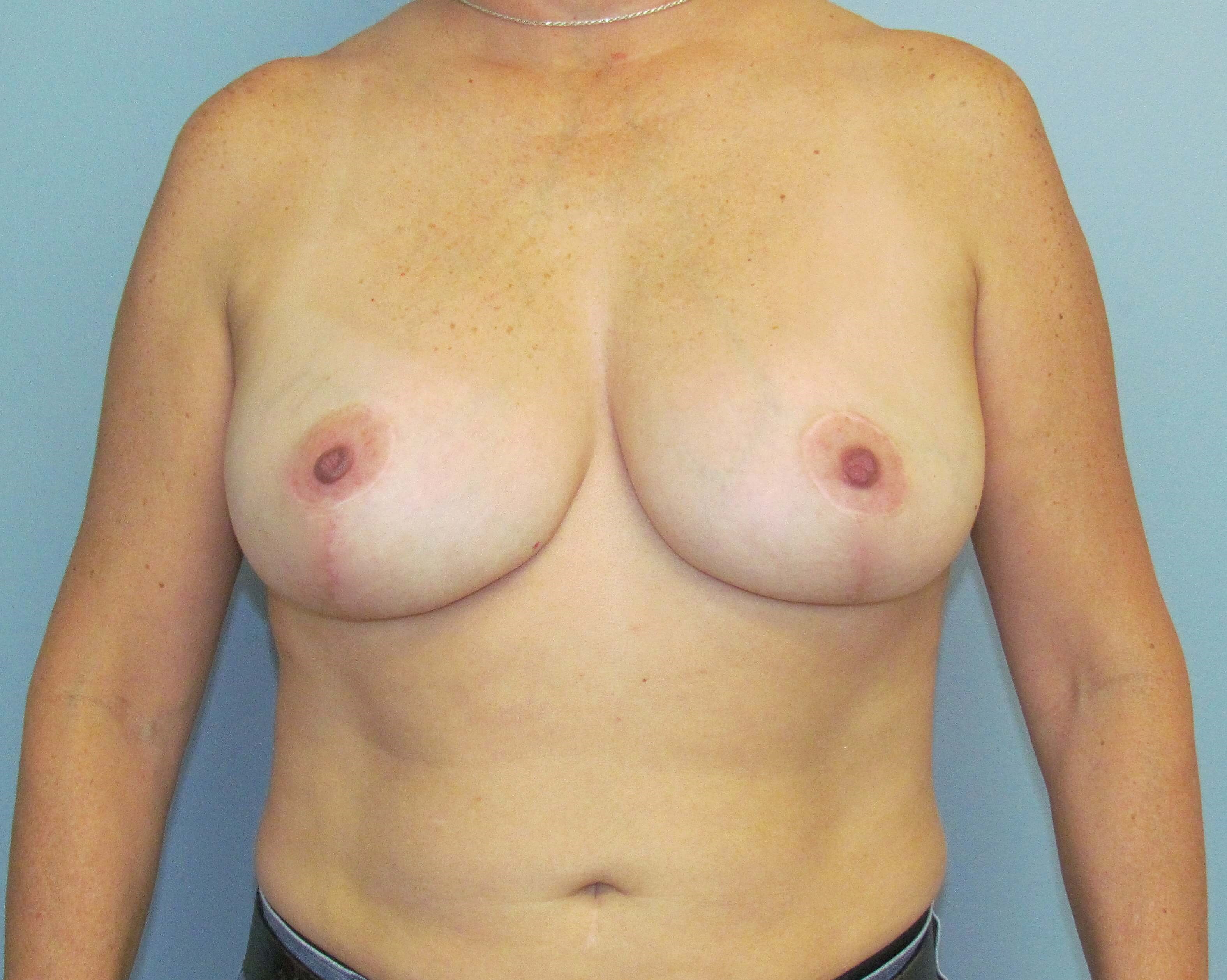 Breast Lift & Liposuction After Breast Lift & Lipo