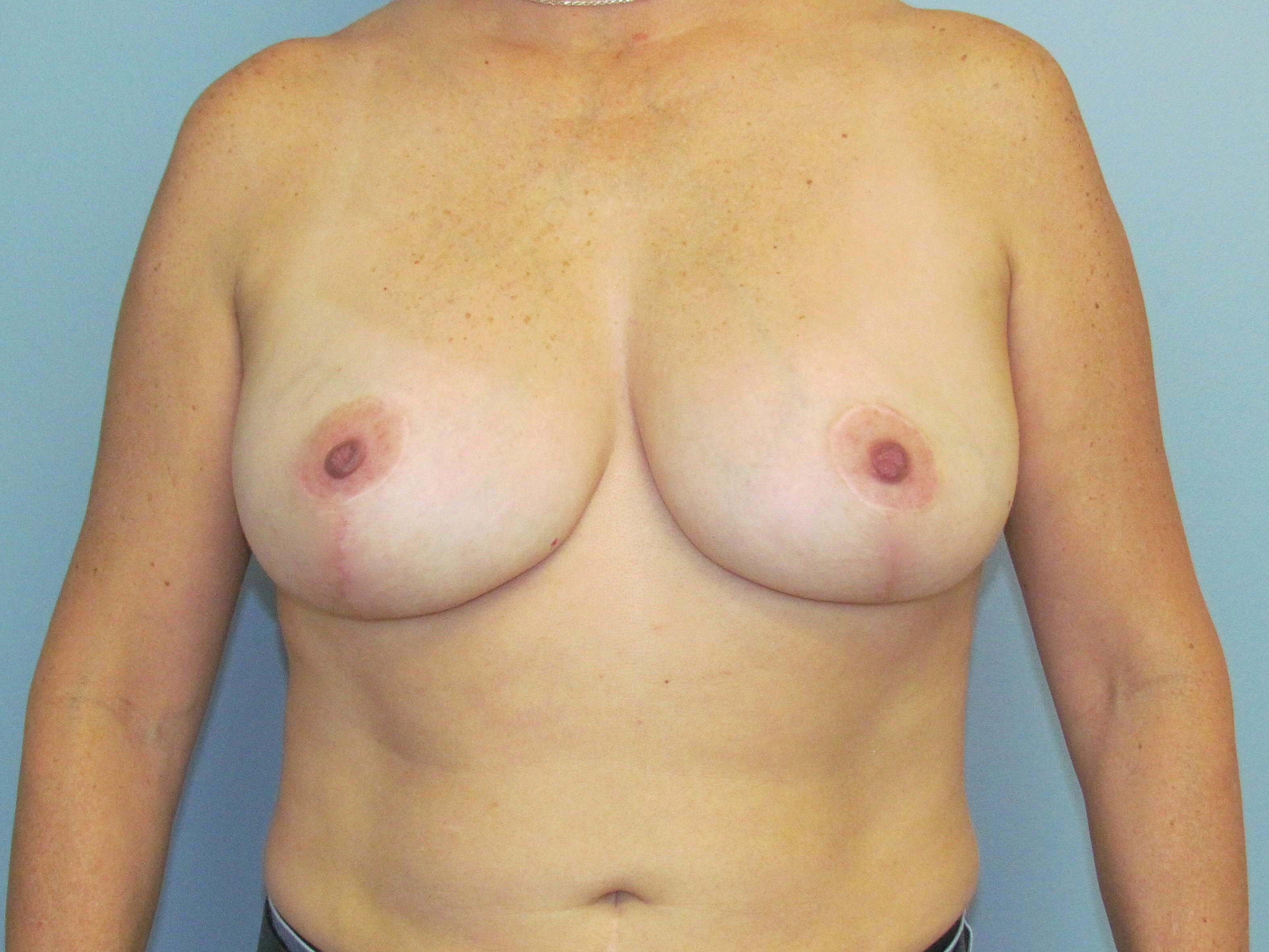 Breast Lift & Liposuction After Breast Lift & Lipo
