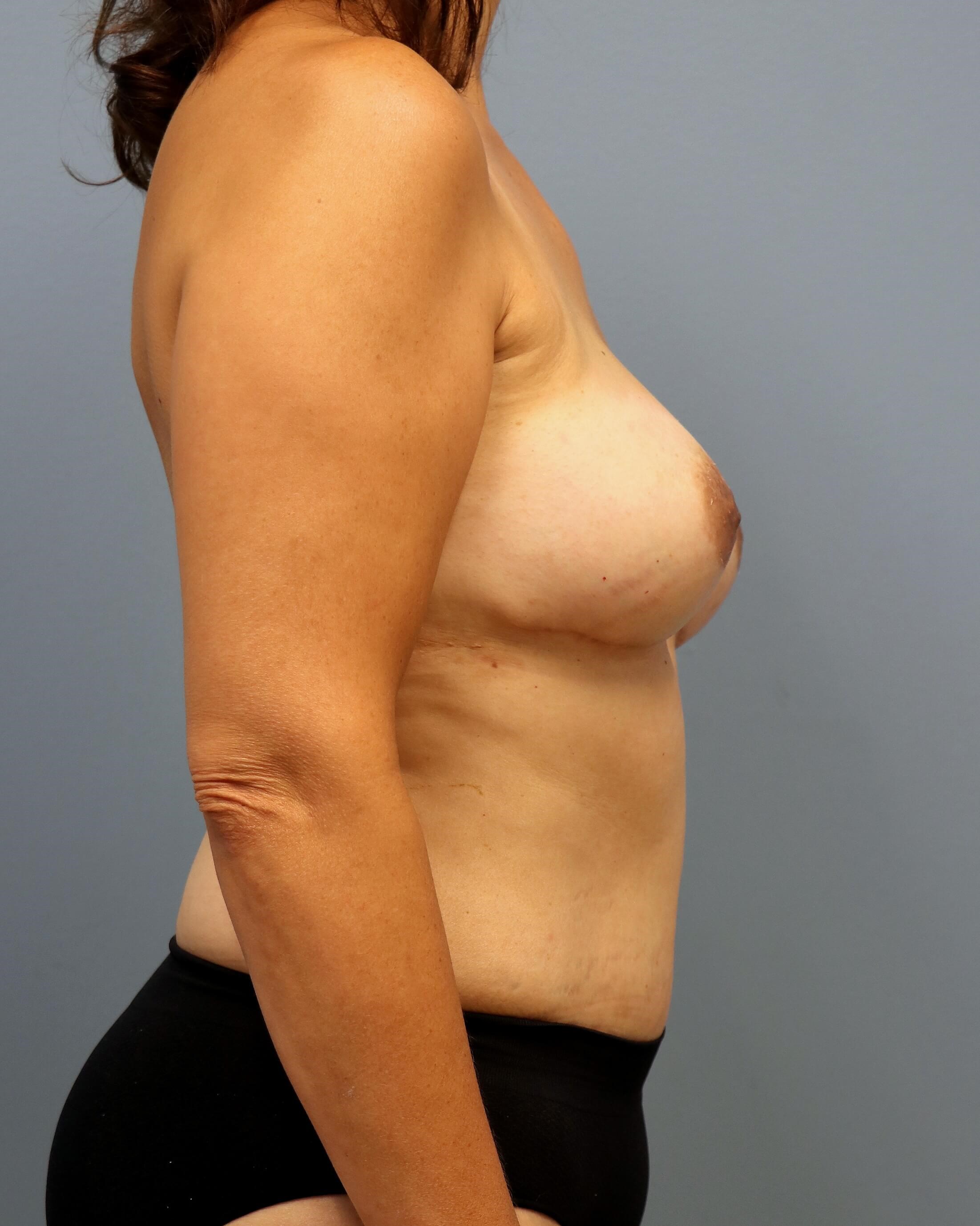 DIEP Flaps with ReSensation After Bilateral DIEP Flaps