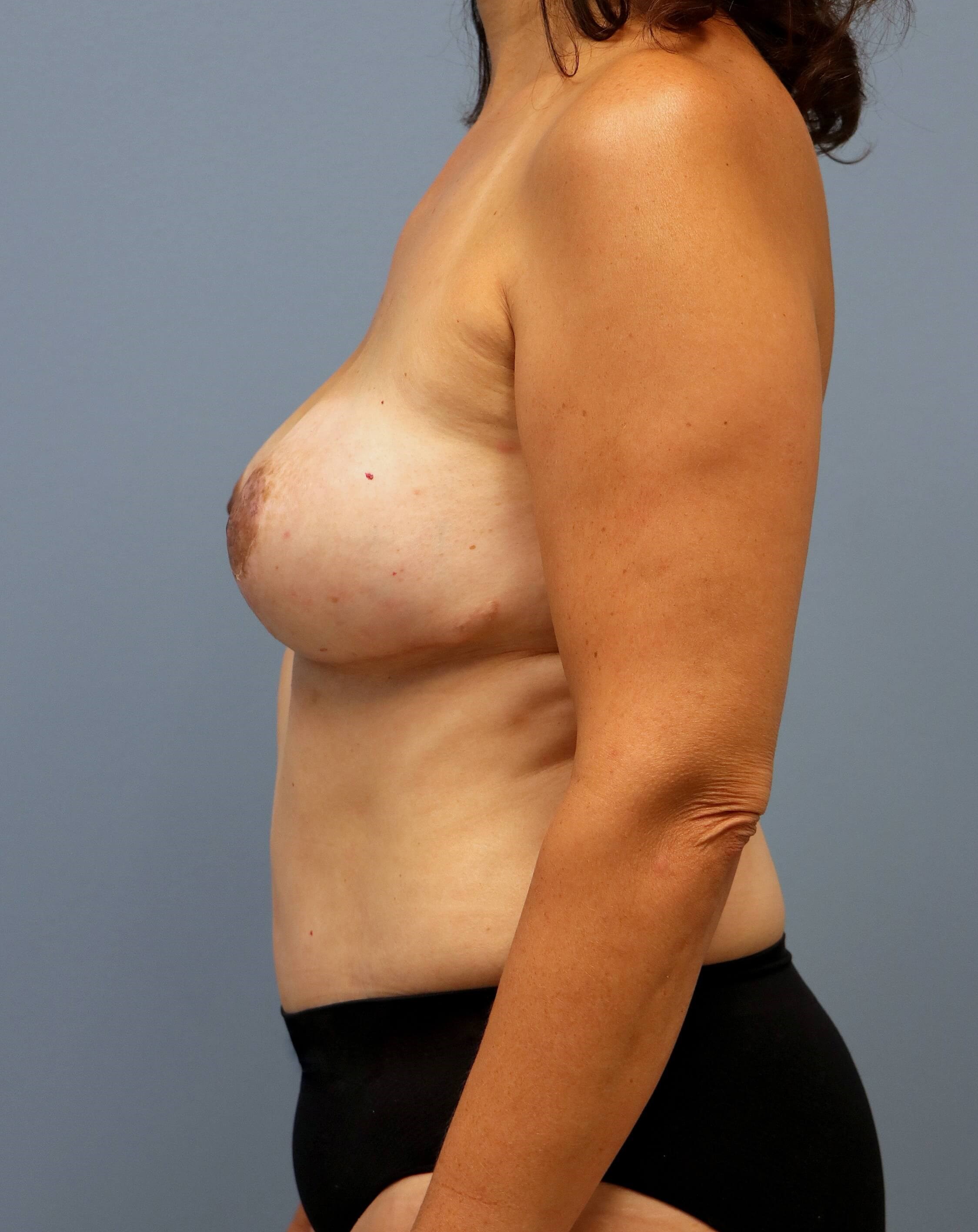 DIEP Flaps with ReSensation After Bilateral DIEP Flaps