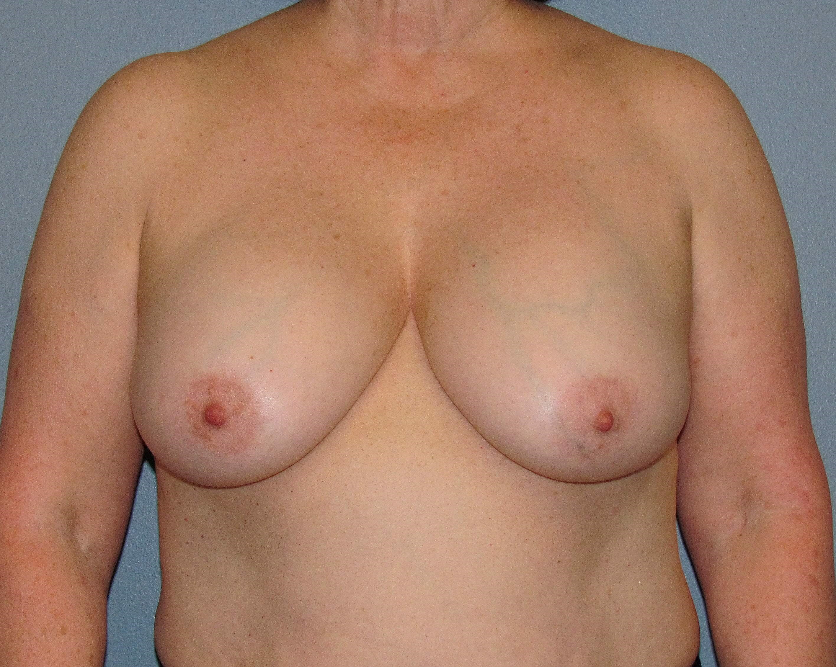 Treating Capsular Contracture Before Revision Breast Surgery