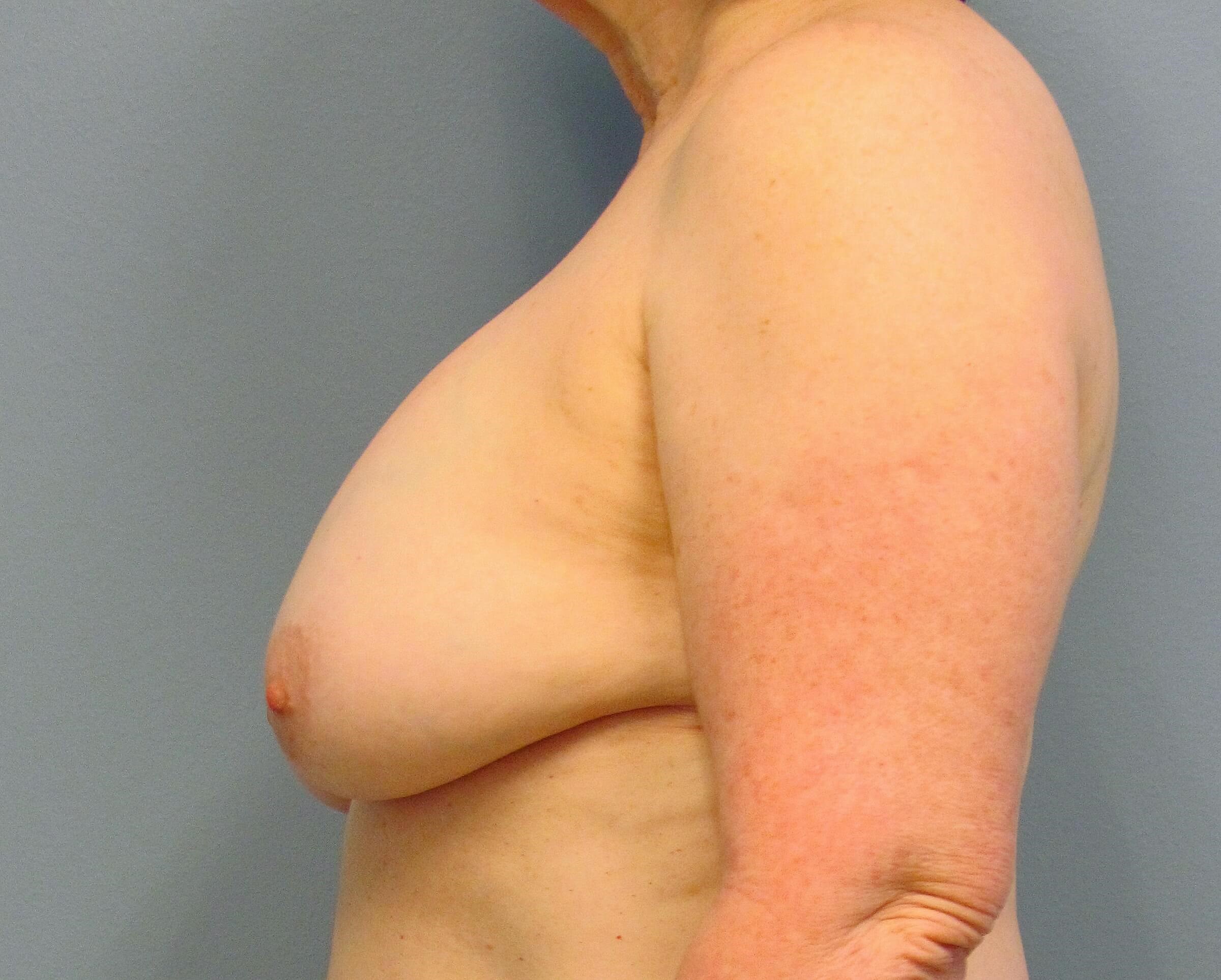 Treating Capsular Contracture Before Revision Breast Surgery