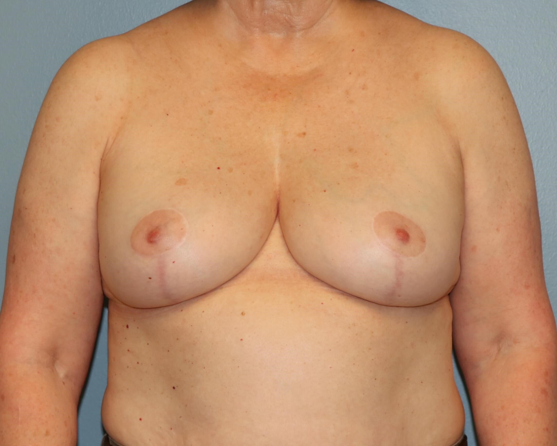 Treating Capsular Contracture After Revision Breast Surgery