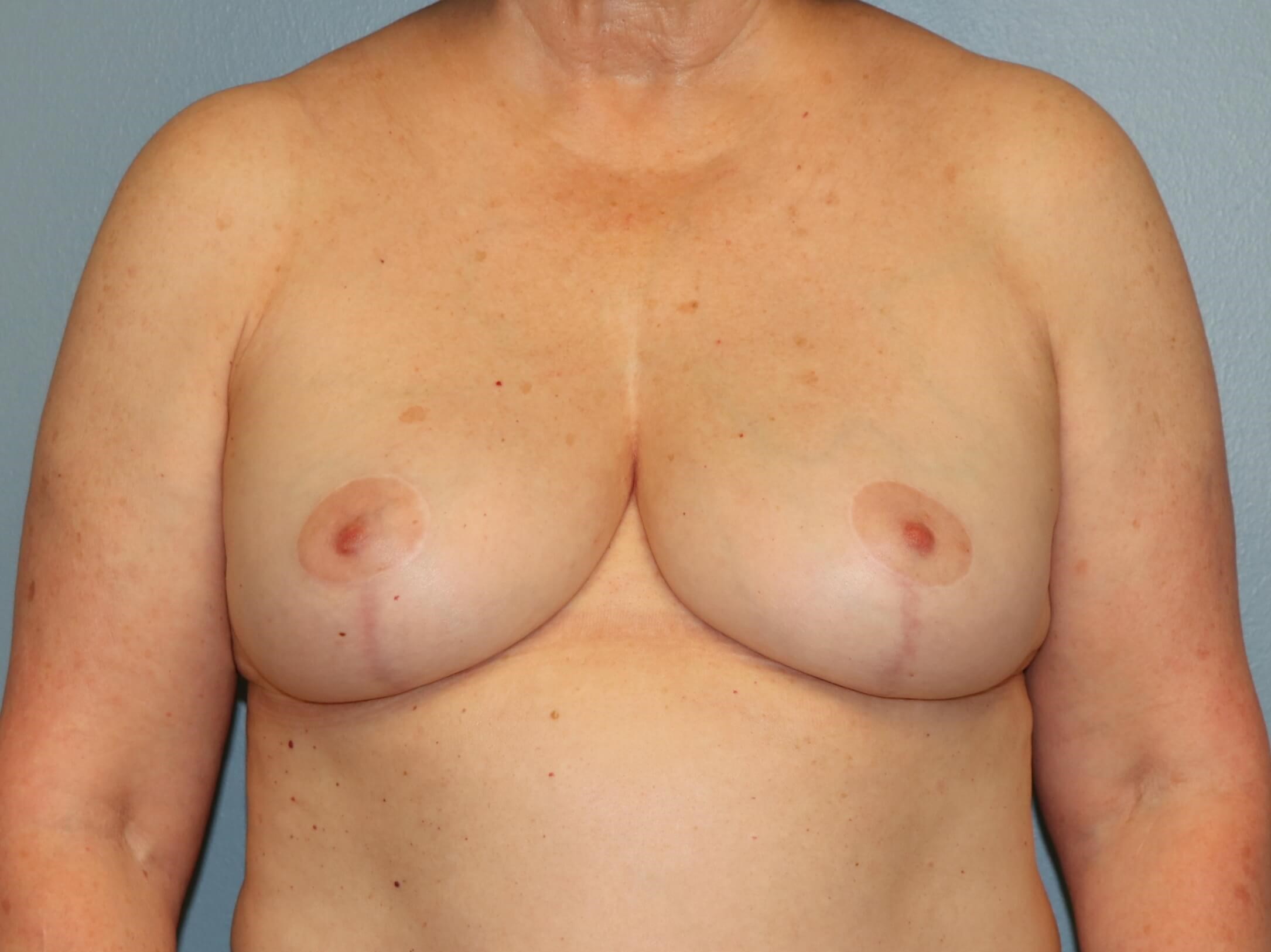 Treating Capsular Contracture After Revision Breast Surgery
