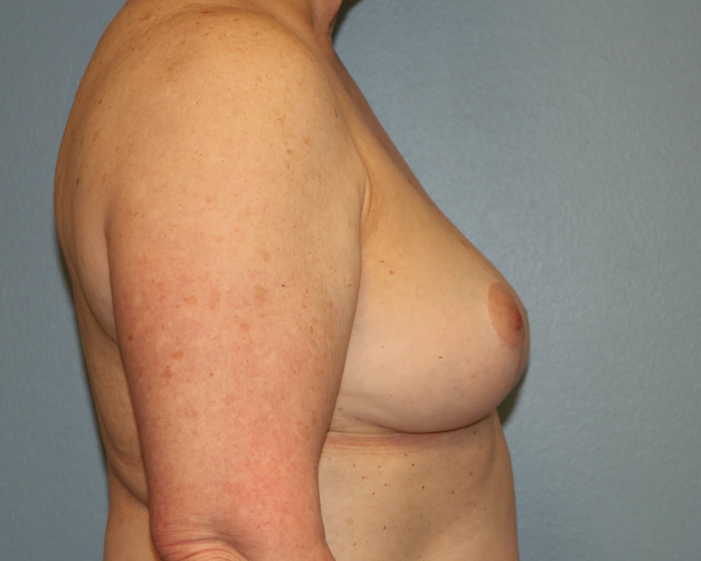 Treating Capsular Contracture After Revision Breast Surgery
