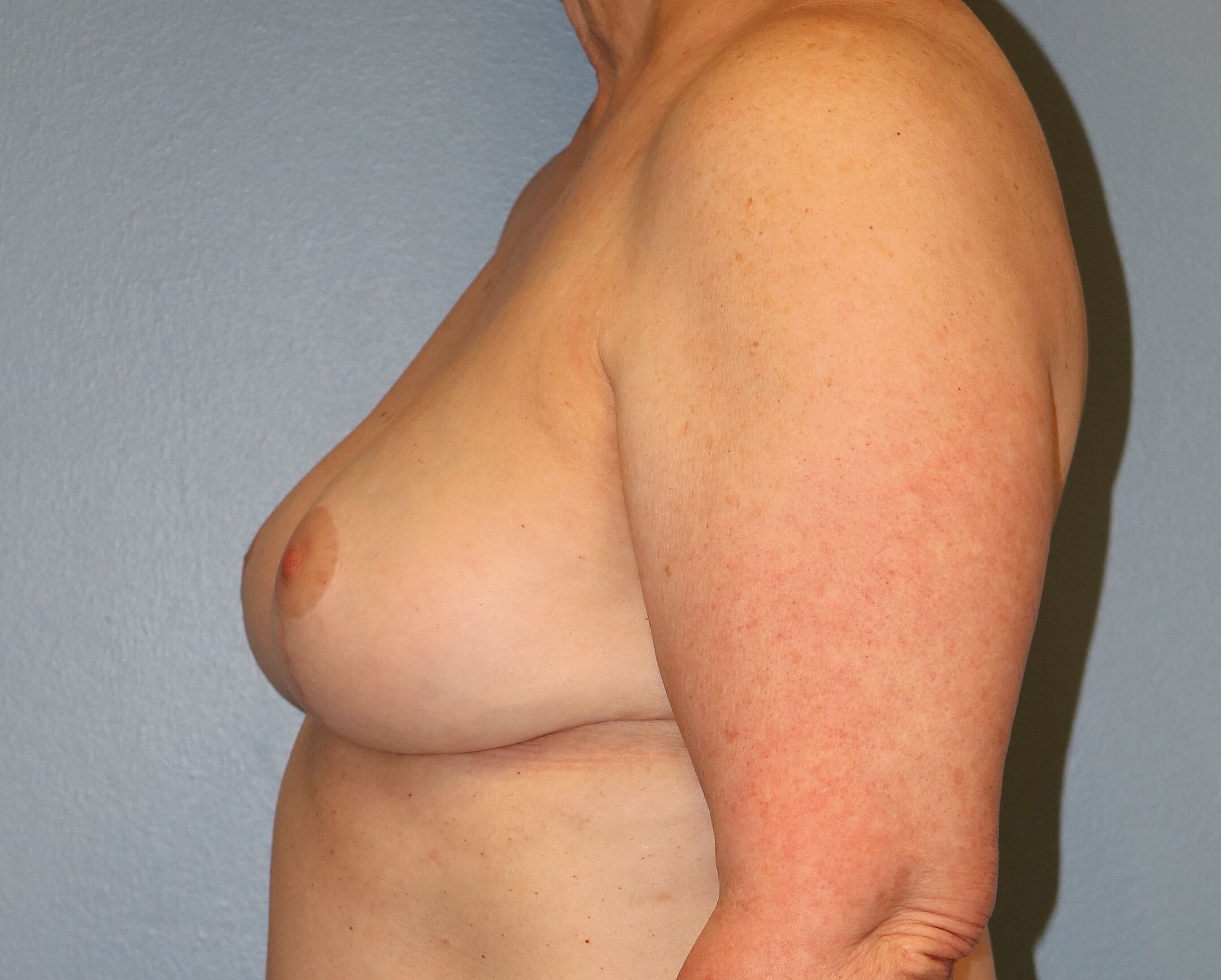 Treating Capsular Contracture After Revision Breast Surgery