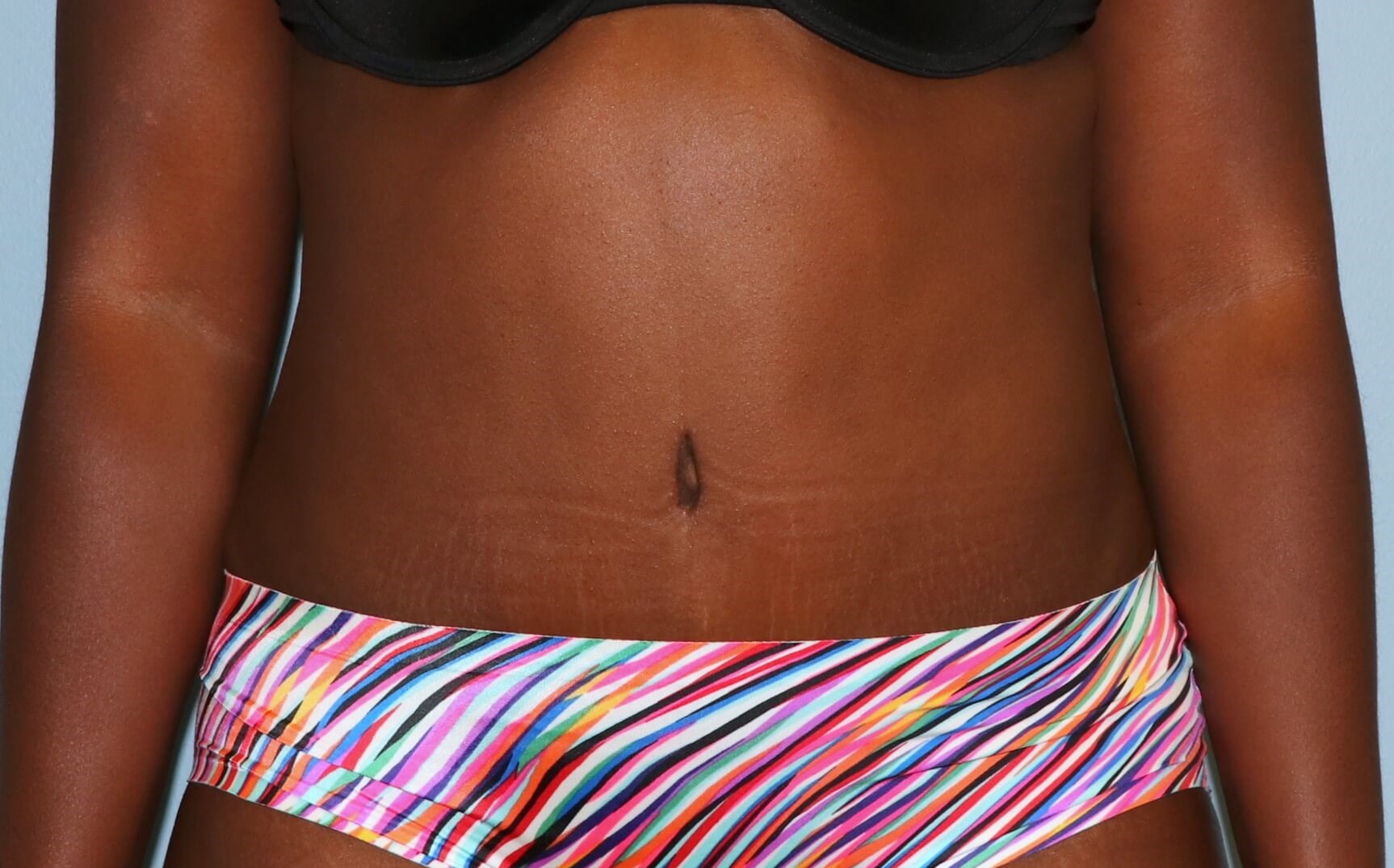 Tummy Tuck Before & After After Tummy Tuck