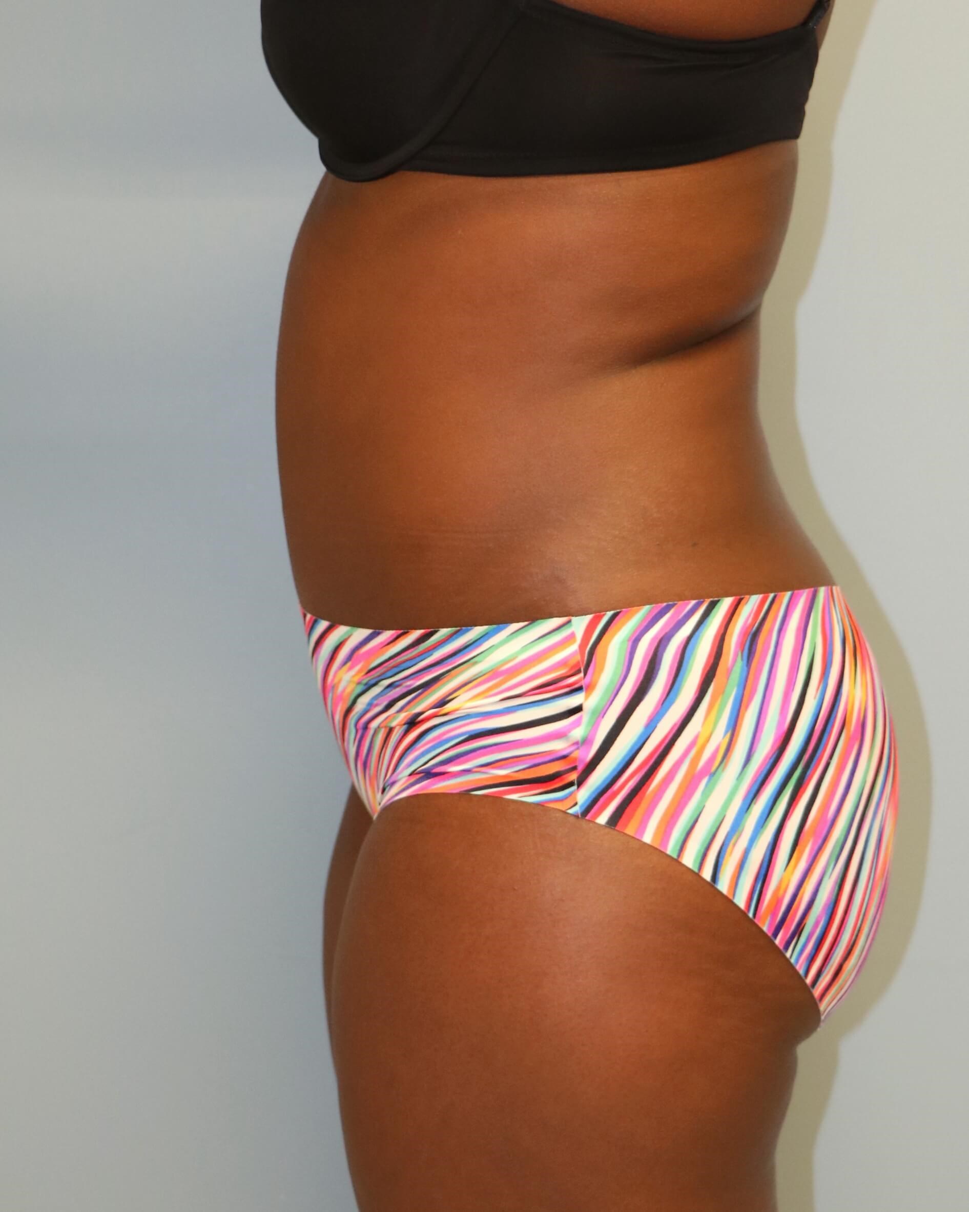 Tummy Tuck Before & After After Tummy Tuck