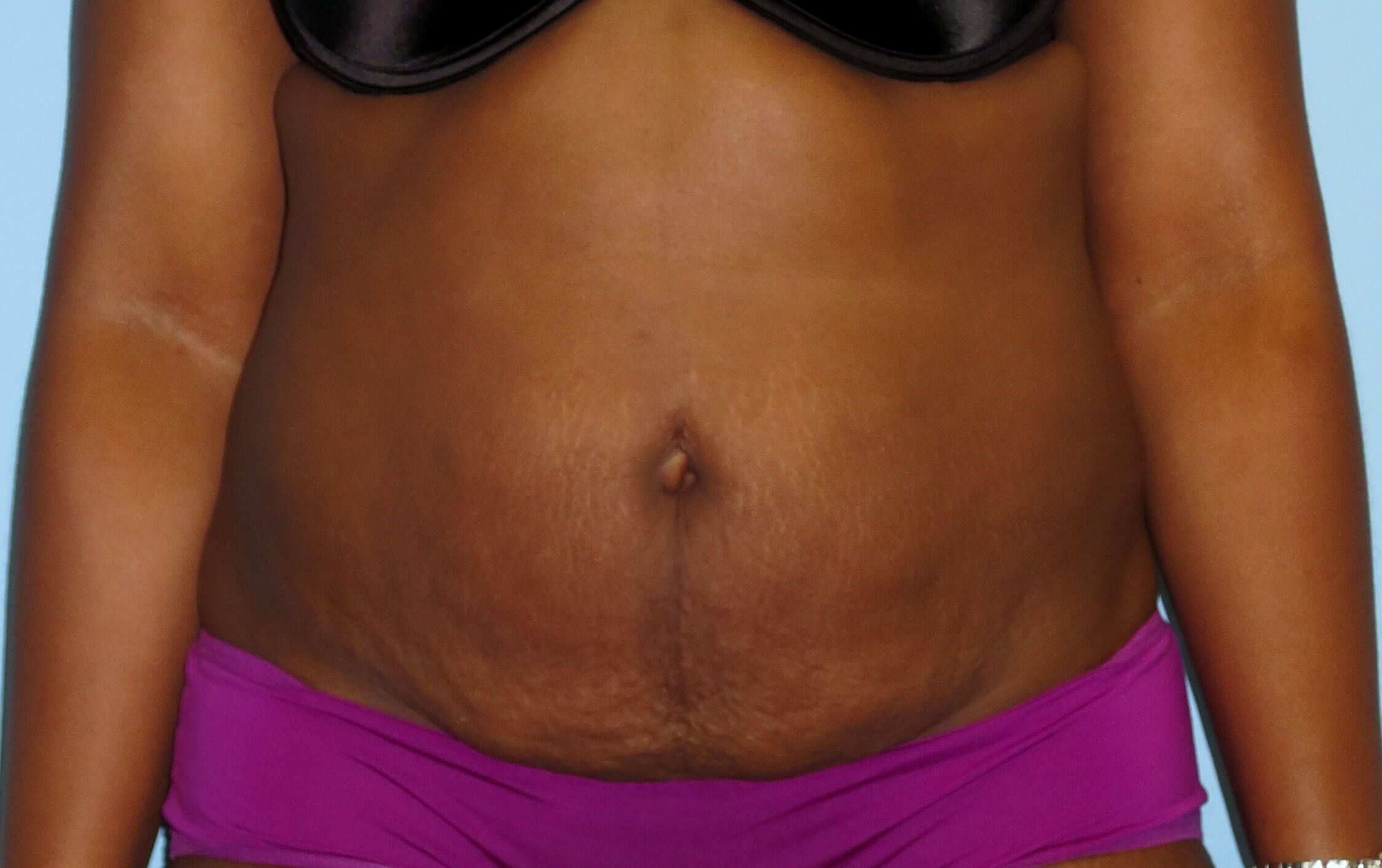 Tummy Tuck Before & After Before Tummy Tuck