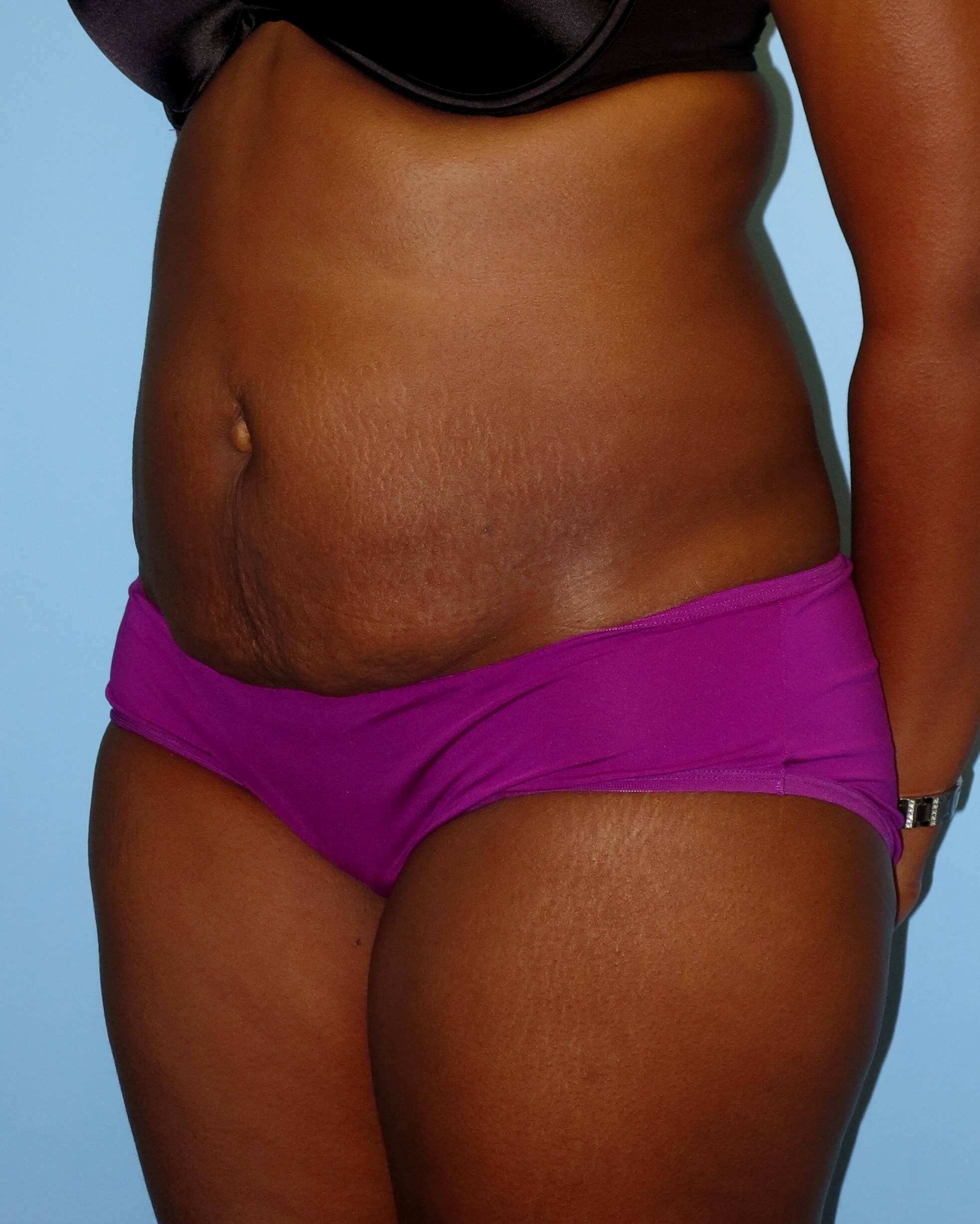 Tummy Tuck Before & After Before Tummy Tuck