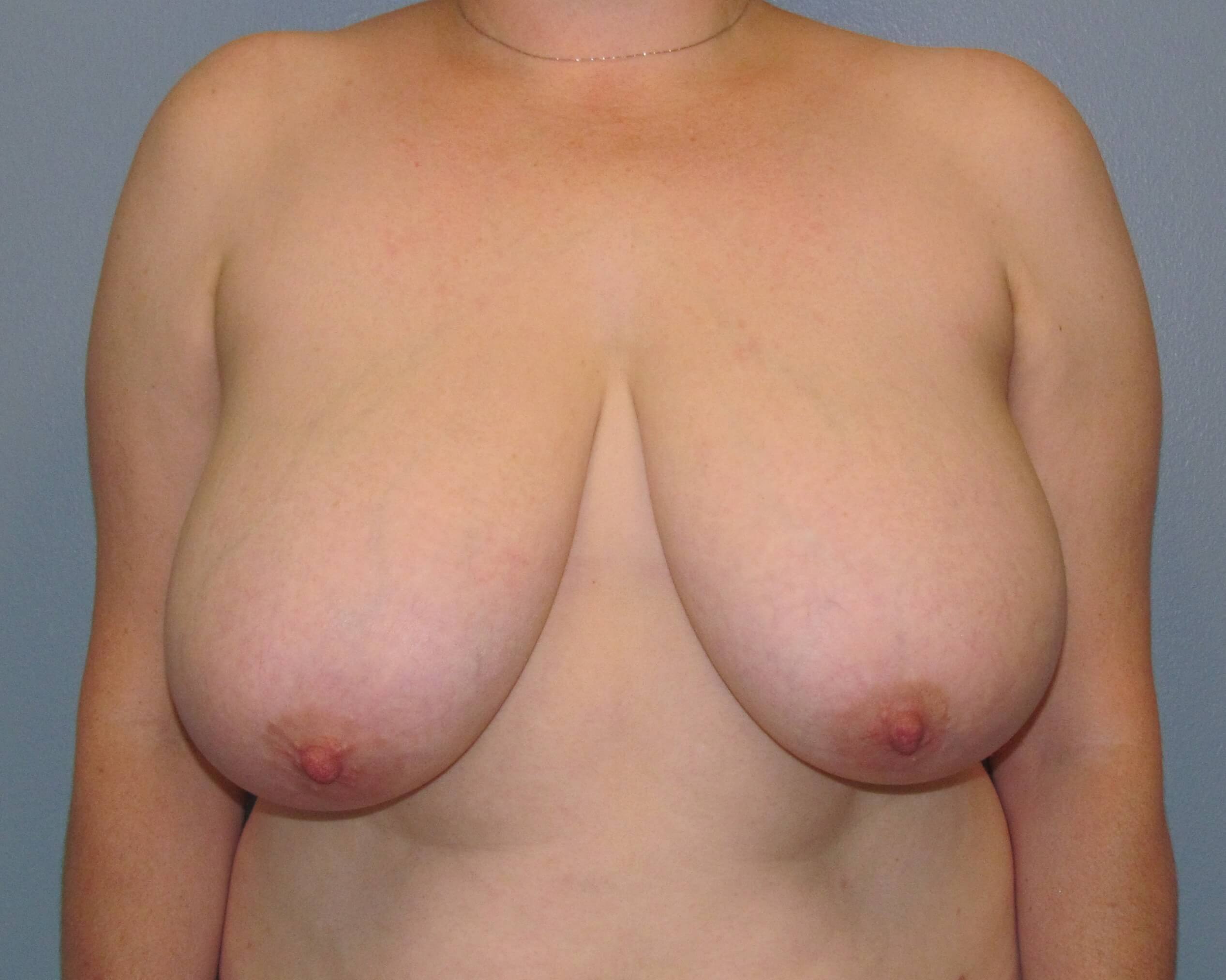 Breast Reduction Before/After Before Breast Reduction