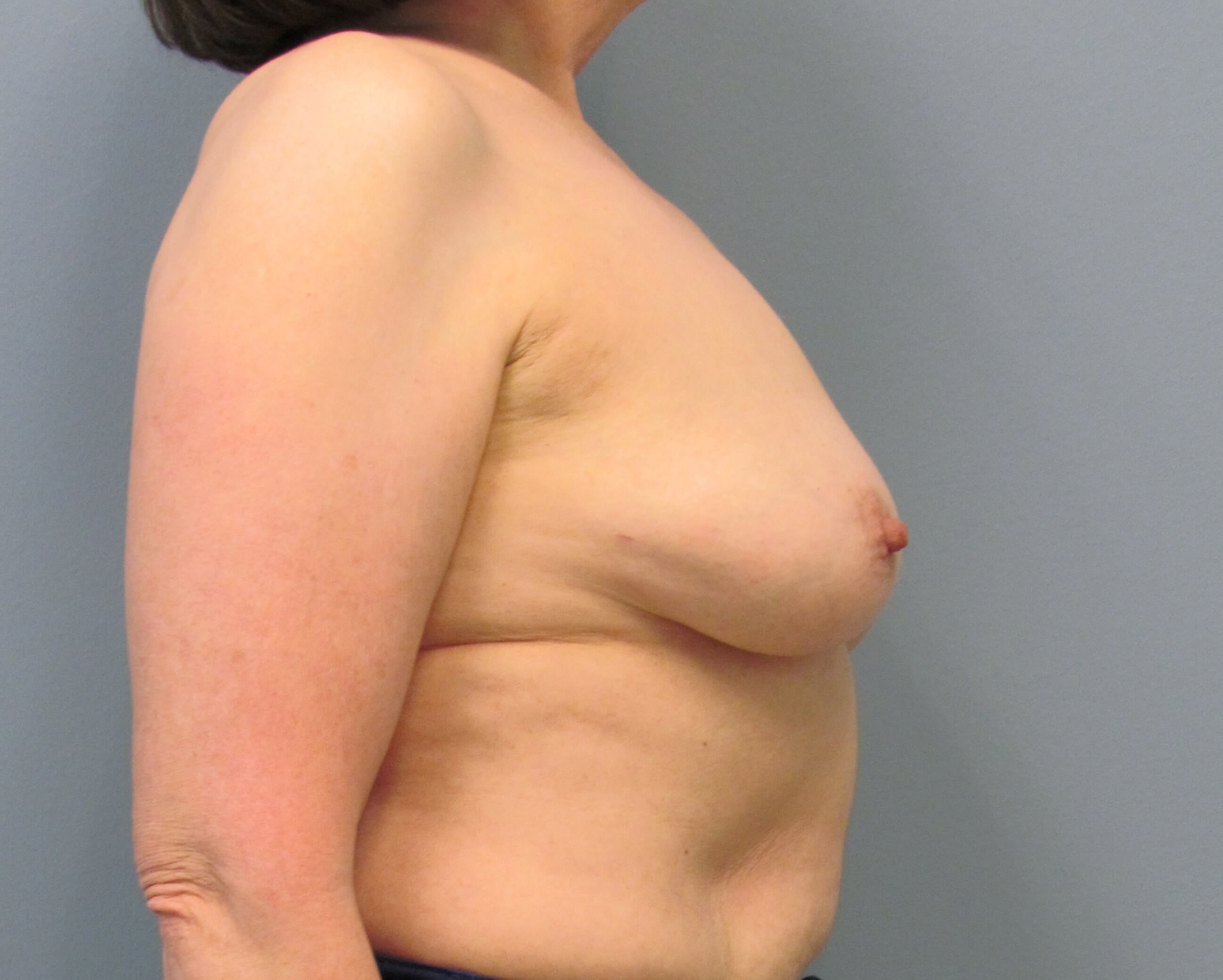 Prepectoral Implant Recon Before Bilateral Mastectomy