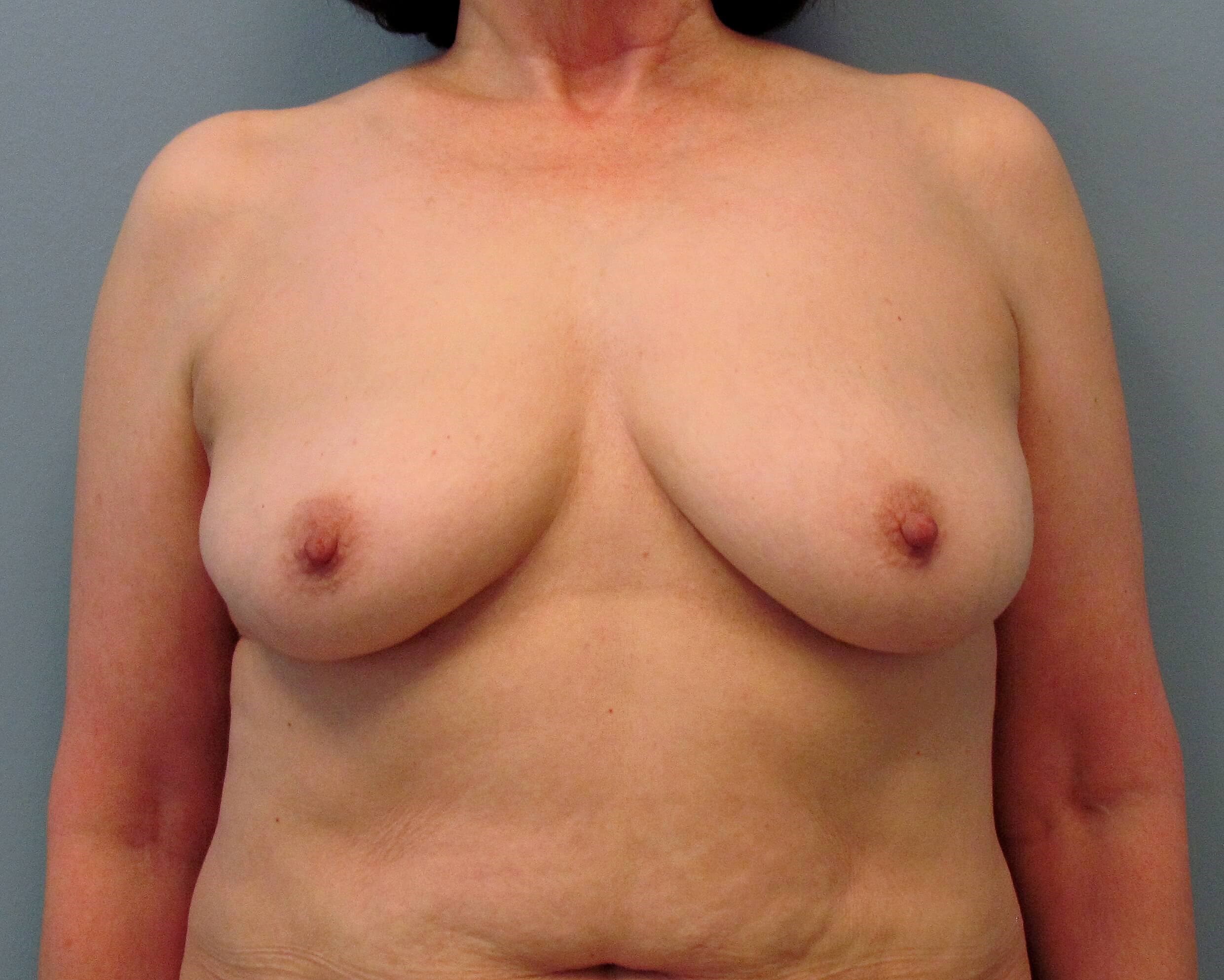 Prepectoral Implant Recon Before Bilateral Mastectomy