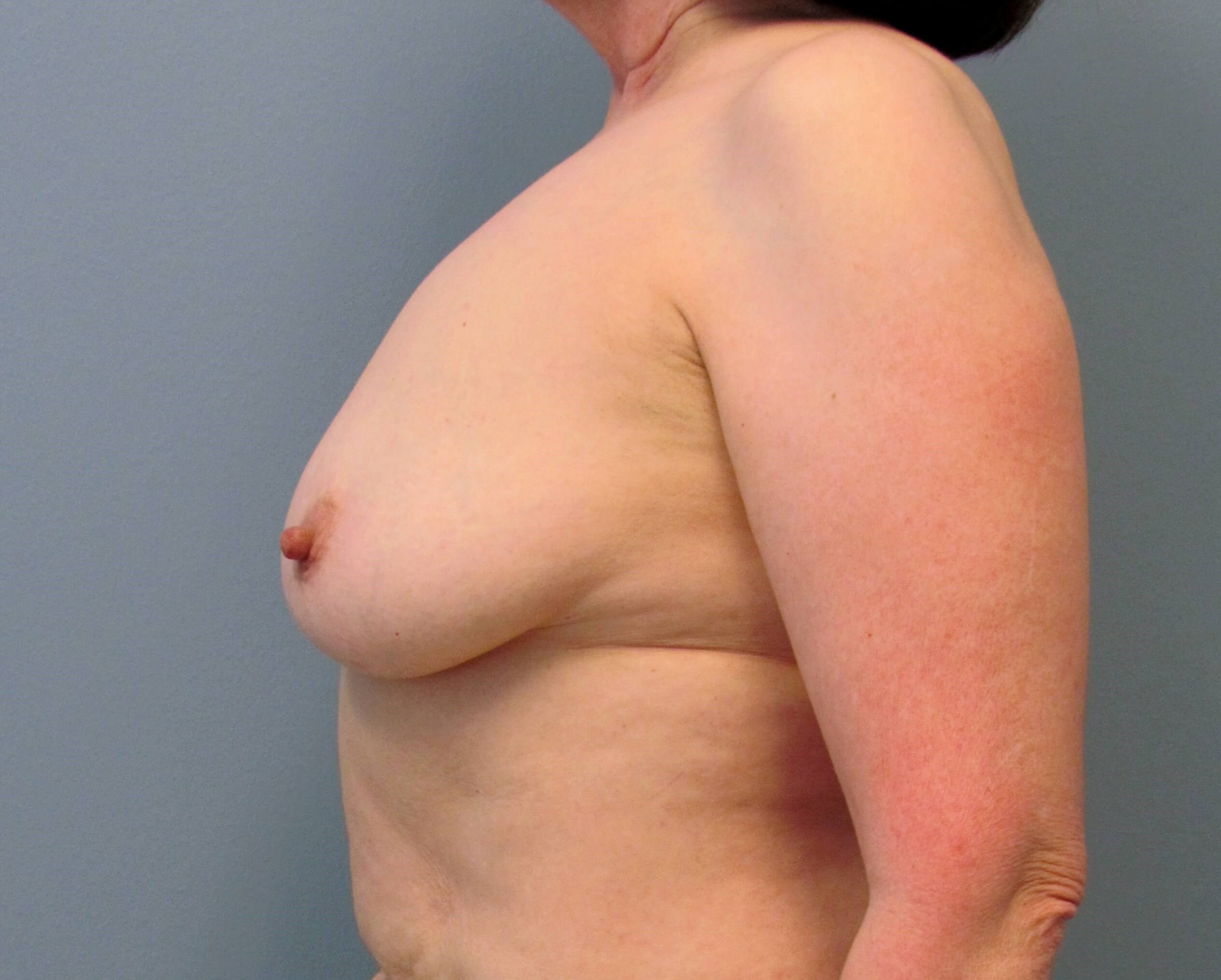 Prepectoral Implant Recon Before Bilateral Mastectomy