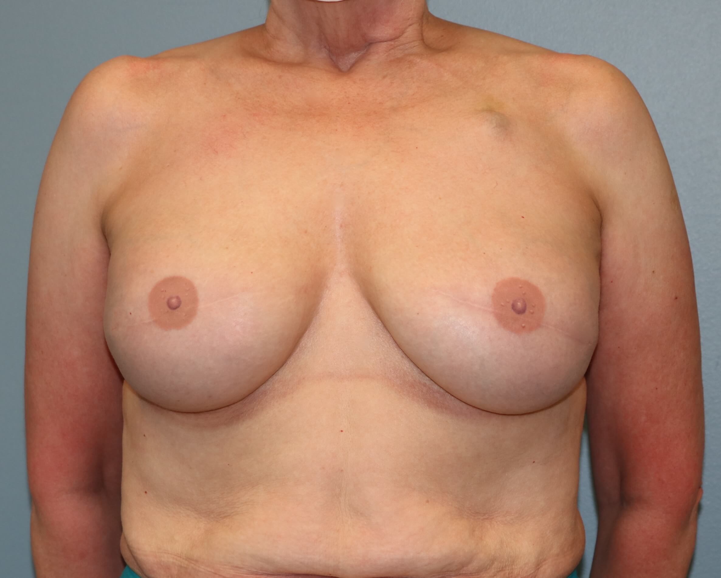 Prepectoral Implant Recon After Implant Reconstruction